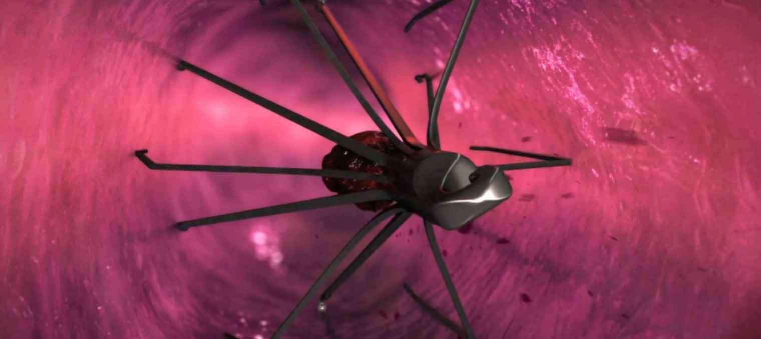 A medical animation still showing the Inferior Vena Cava Filters working to Prevent Pulmonary Embolism