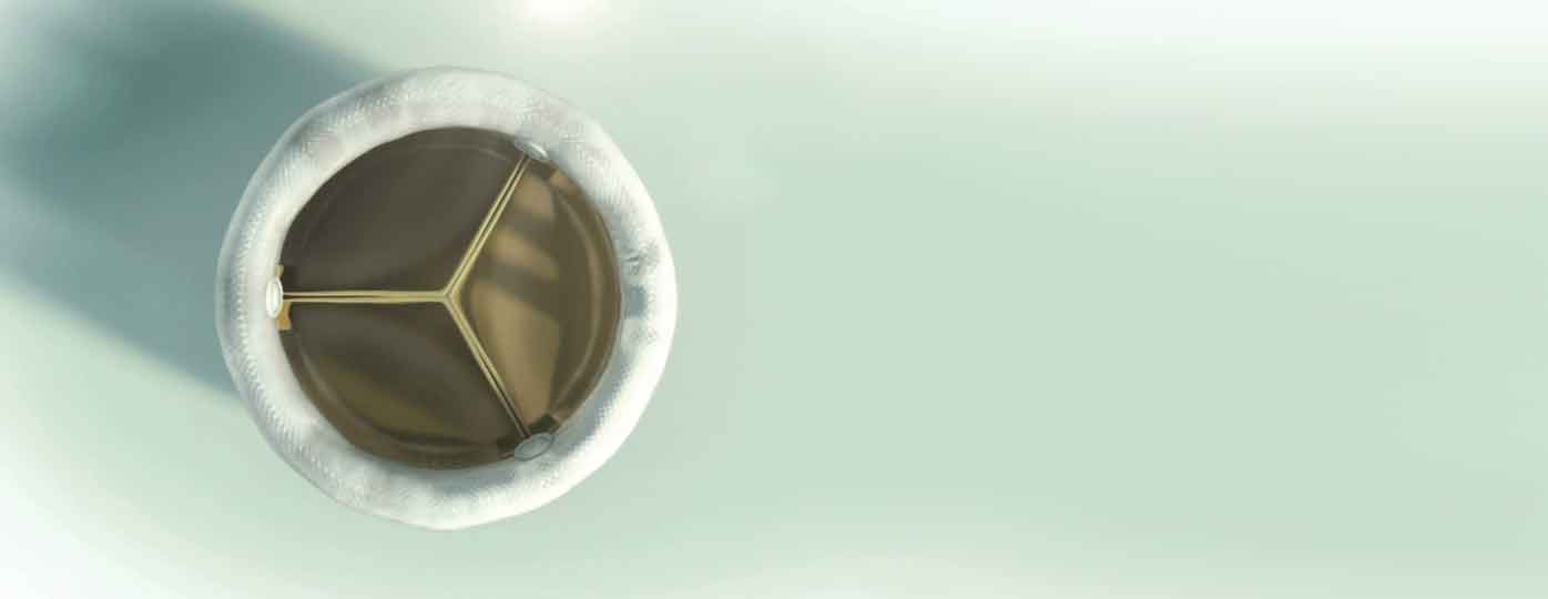 DirectFlow Aortic Valve Implant displayed on a counter