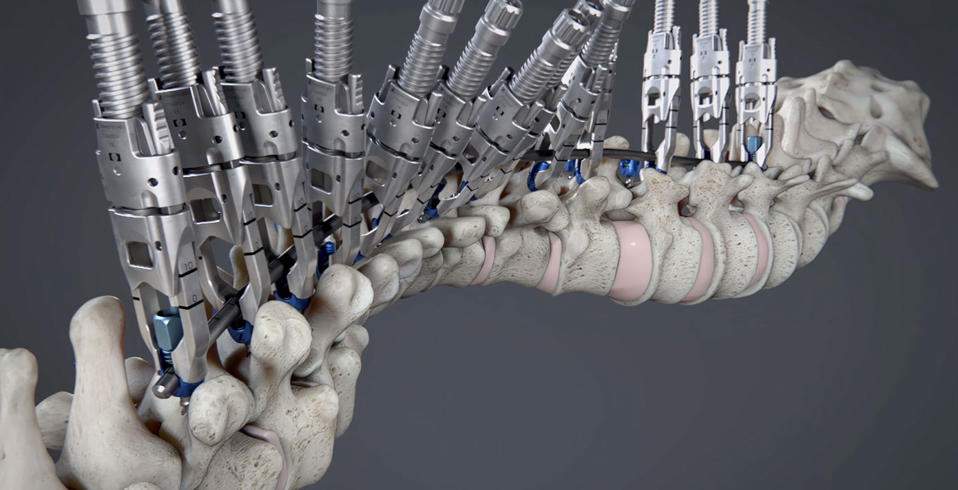 Medical Animations showing Spine Surgery