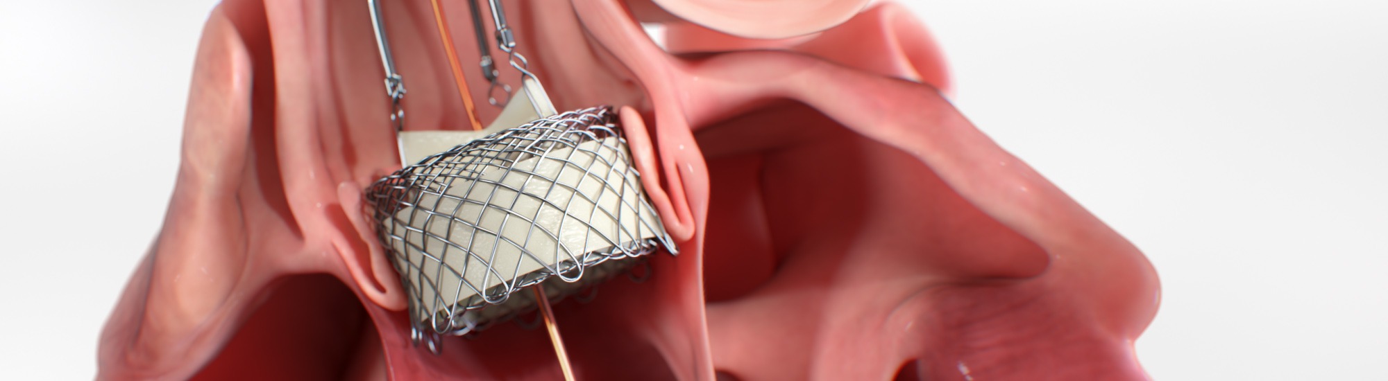 HLT Medical custom TAVR animation created by Ghost Medical