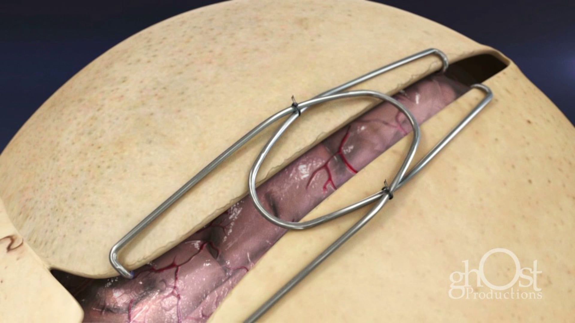 Ghost Medical - Osteomed - SmartFlex - HD