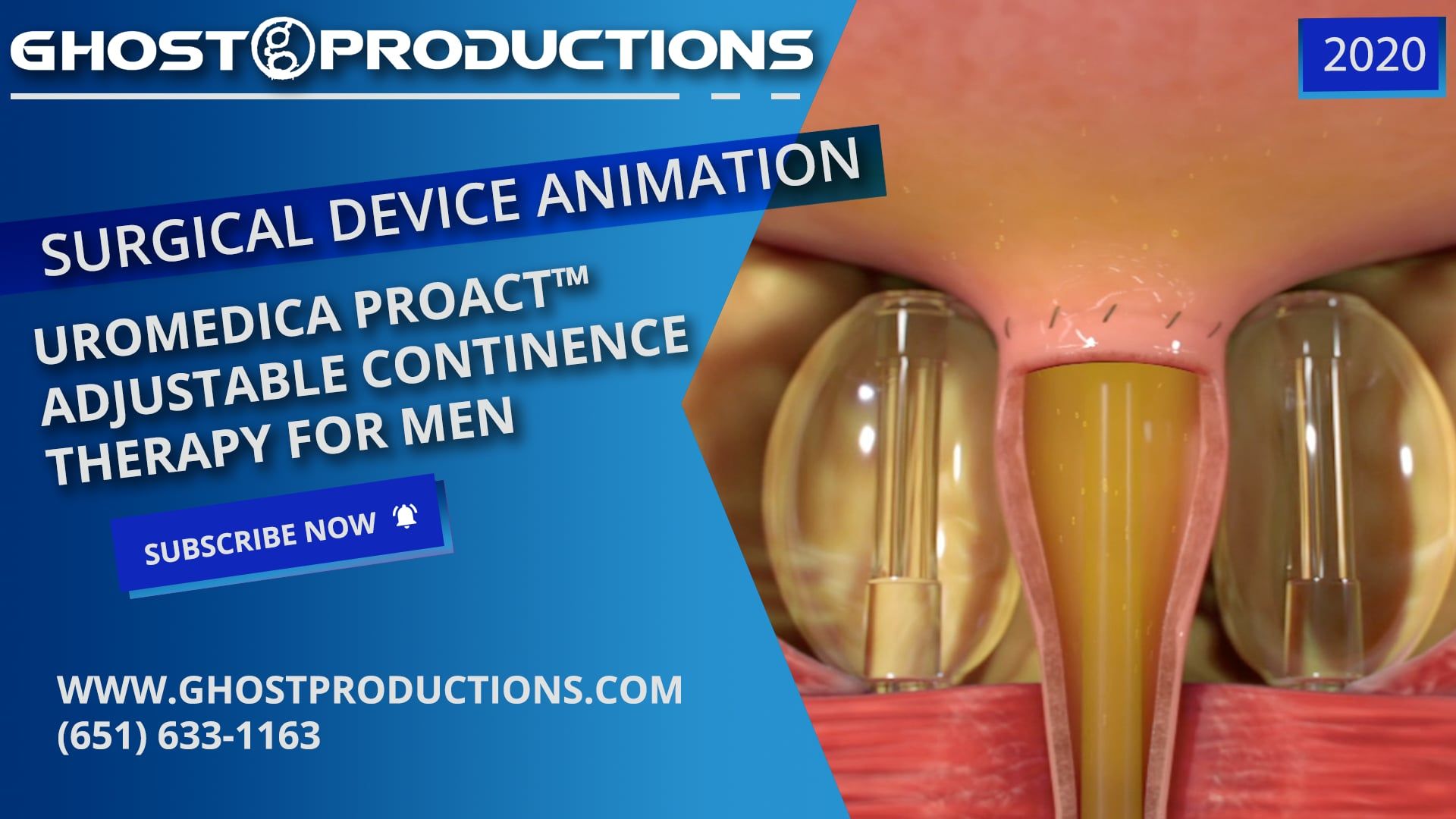 Uromedica ProACT™ Adjustable Continence Therapy for Men | Video