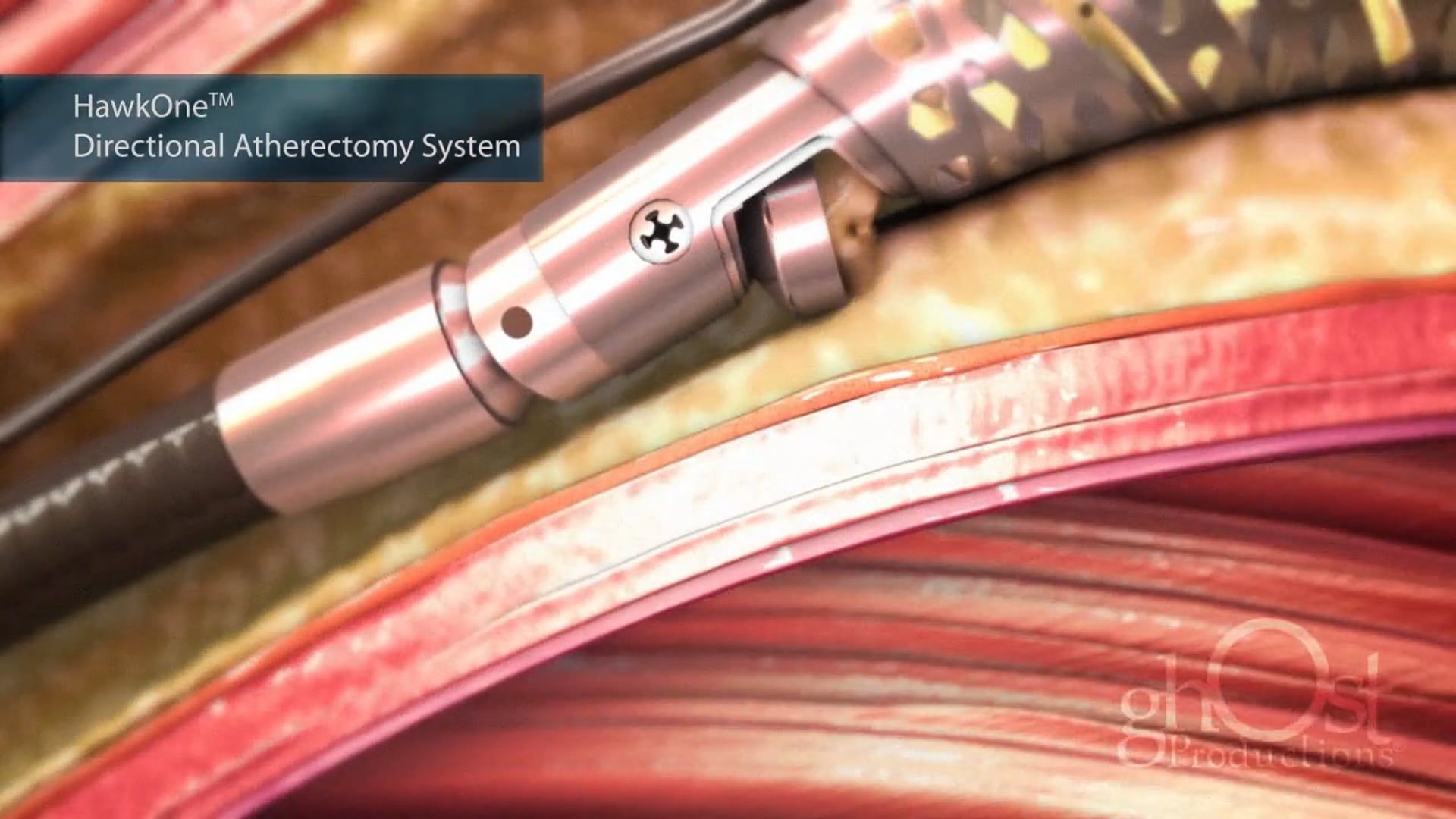 Medtronic, HawkOne device, interventional cardiology, animation, Ghost Productions, directional atherectomy, PTA balloon, arterial blockages, medical accuracy, innovative product, medical professionals, patients, advancing field, commitment.