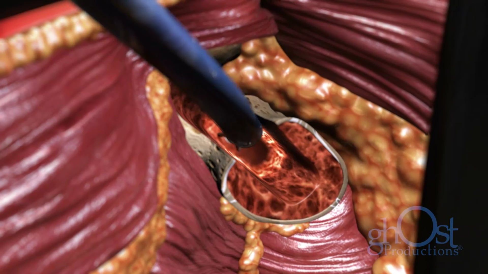 Invuity, medical technology, surgical illumination, brand identity, animation, innovation, cutting-edge technology, enhanced visualization, improved patient outcomes, surgical procedures, advancements, modern medicine.