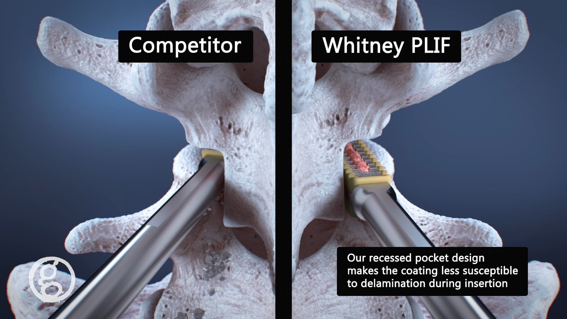 Medical Device Marketing - Zavation Whitney PLIF - Ghost Medical Animation & Surgical VR