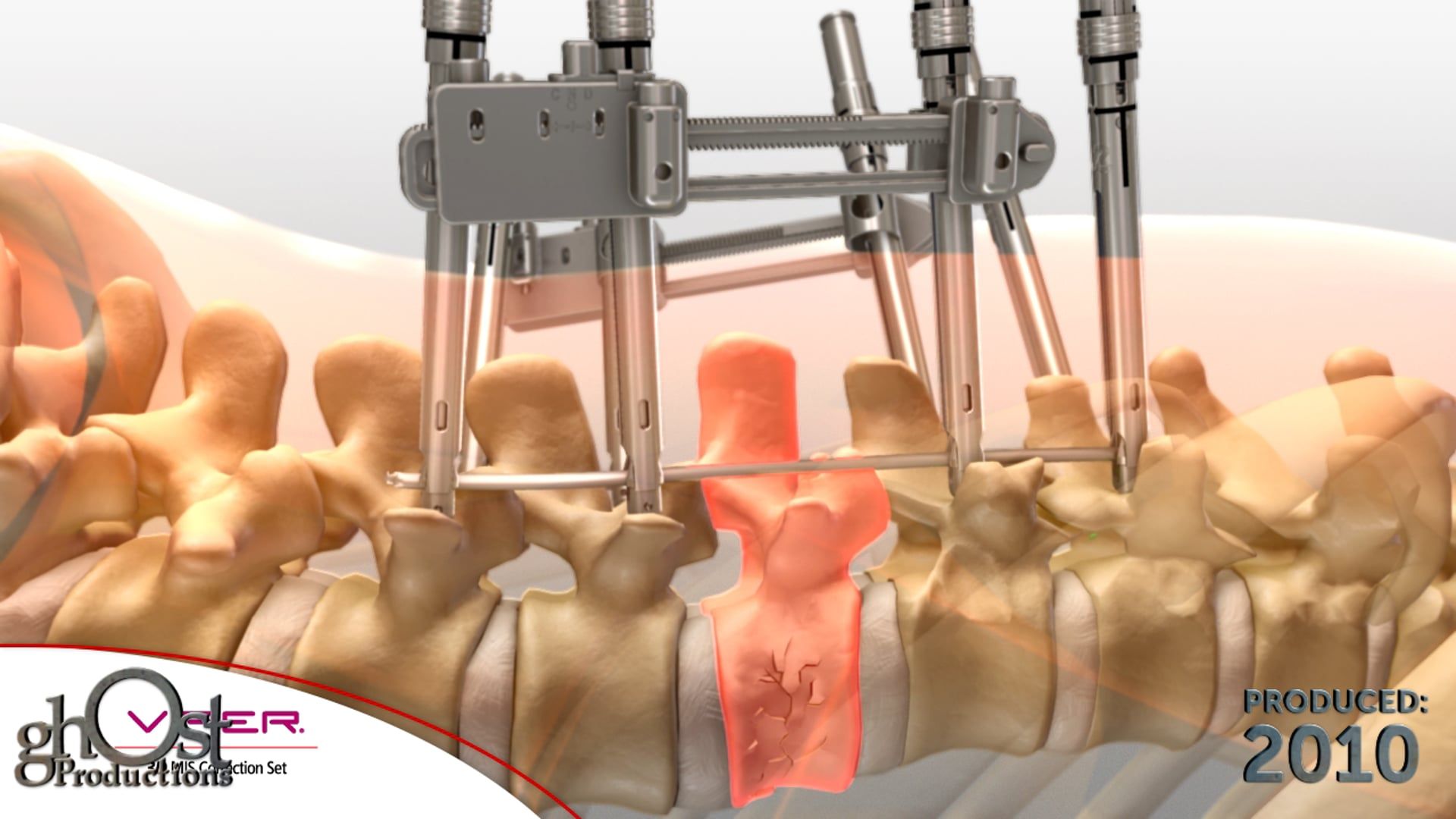 Depuy, Viper 3D, minimally invasive tool, surgeons, thoracolumbar spine, animation, compression fracture, adjacent vertebrae, innovative device, precise, effective solution, spinal surgeons, multiple conditions, showcase, capabilities, product, medical professionals, patients, benefits, advanced technology, spinal medicine.