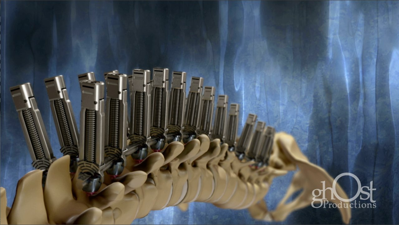 Watch several spinal injuries and pathologies are treated with the radical new medical technology