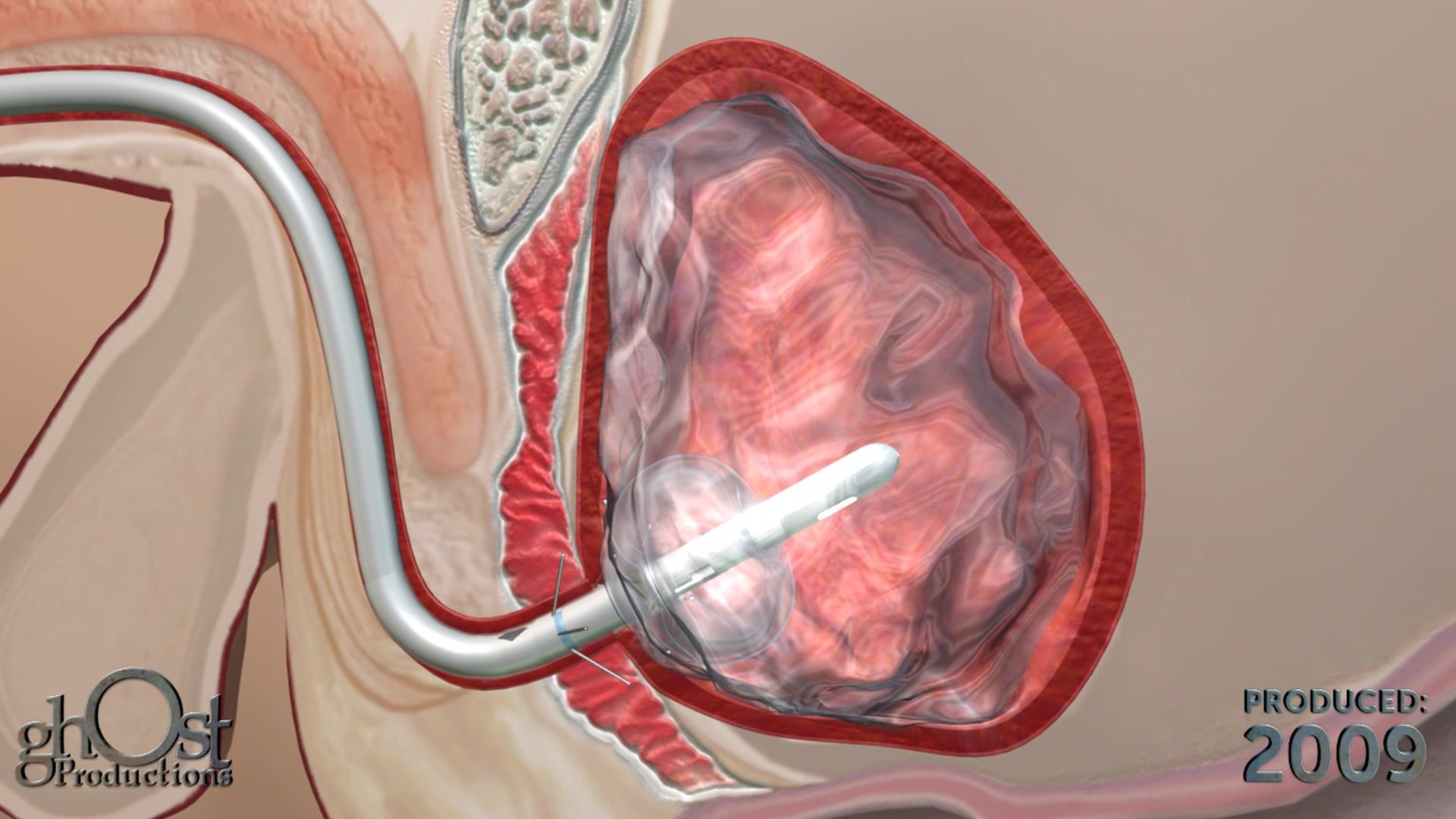 Ghost Medical's American Medical Systems Continuum