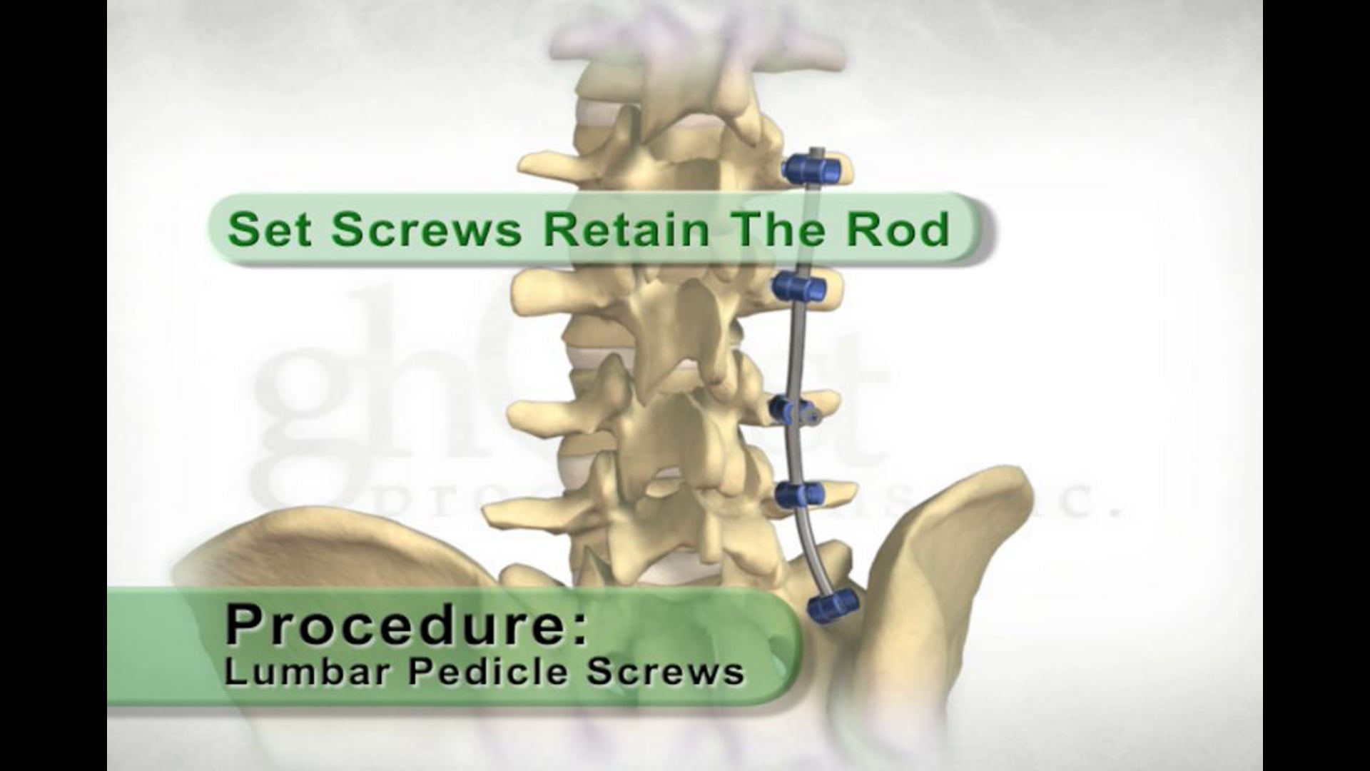 medical animation, pedicle screws, support rods, spinal position, orthopedics, spinal surgery, Ghost Productions, polyaxial head, retention screws, vertebrae, medical professionals, medical students