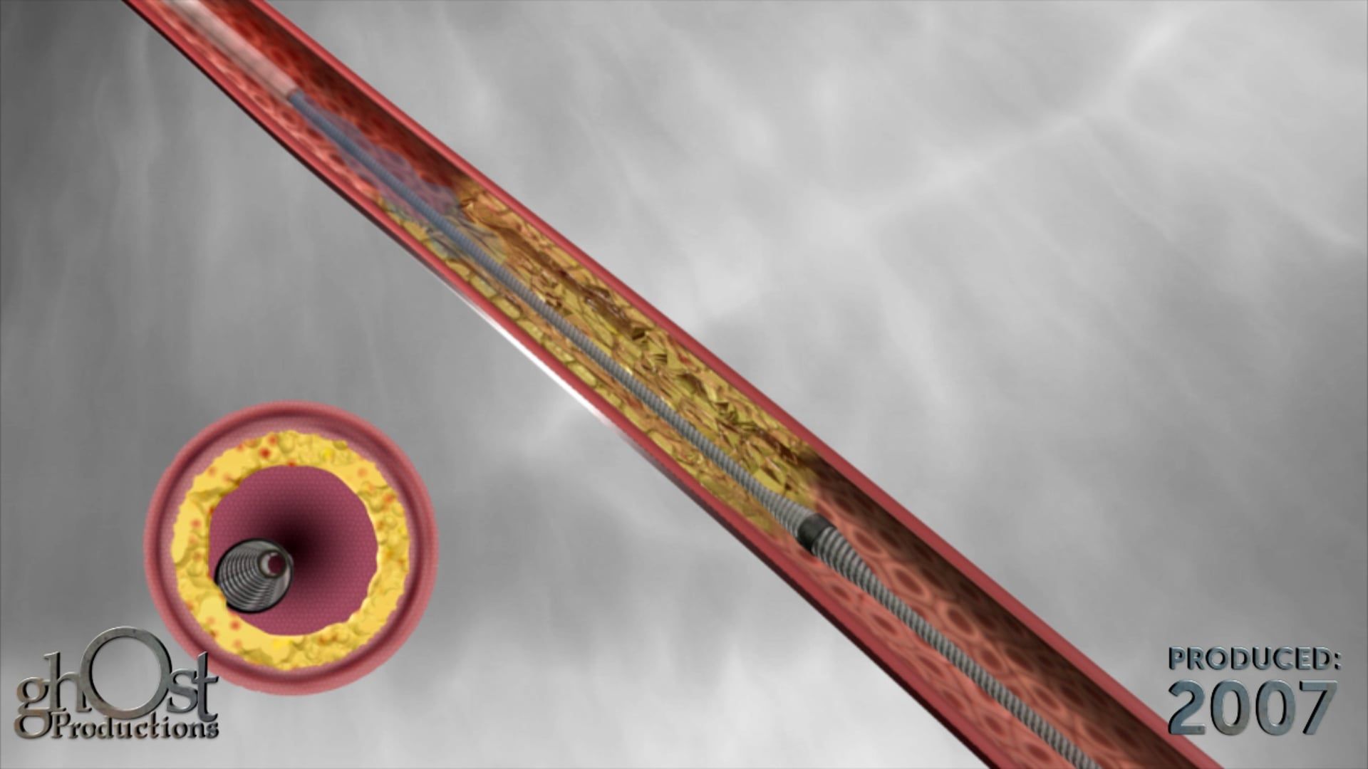 Ghost Medical's CSI360 Diamondback: A Revolutionary Medical Animation