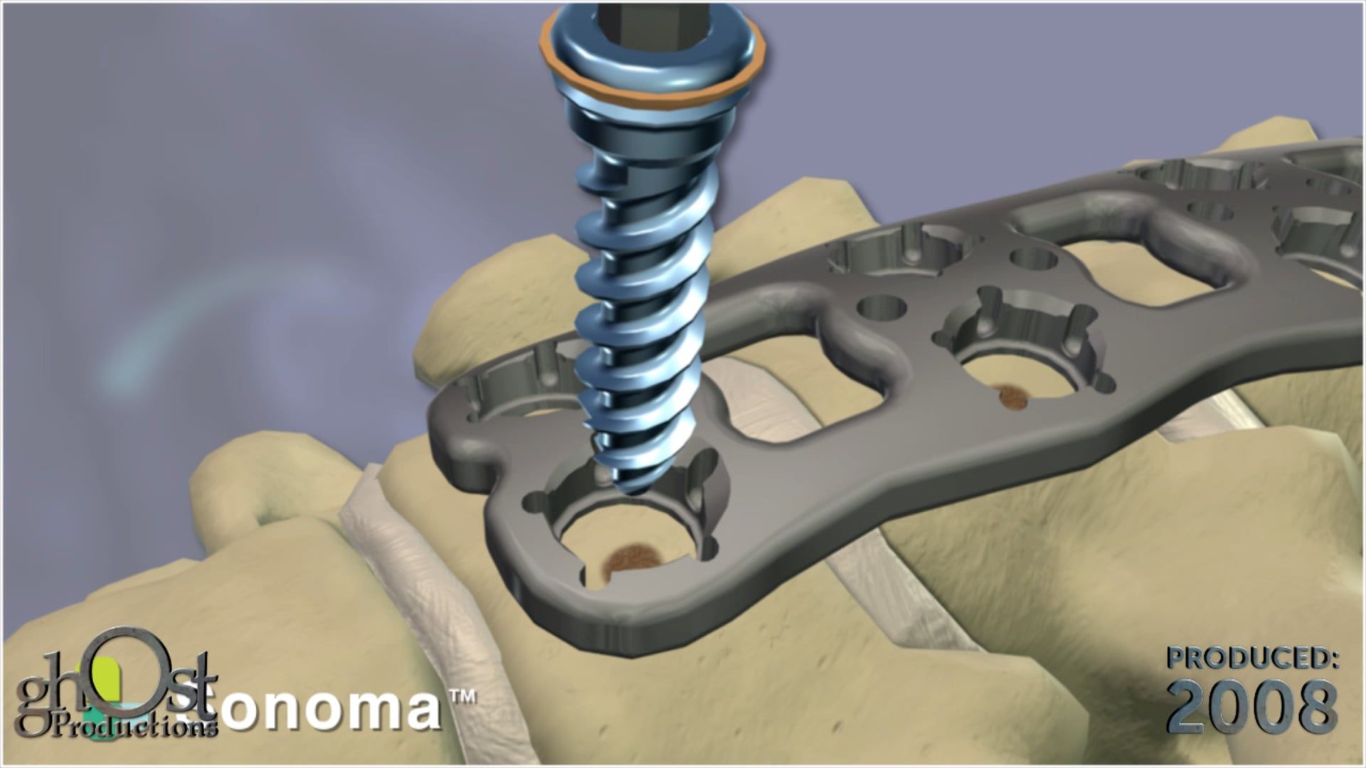 SeaSpine, Ghost Productions, Sonoma vertebral plating device, customized fit, unique anatomy, screws, plating systems, medically accurate, advanced features, benefits, healthcare professionals, patients, spinal surgery, orthopedic medicine, innovative medical devices, improve outcomes, patient outcomes.