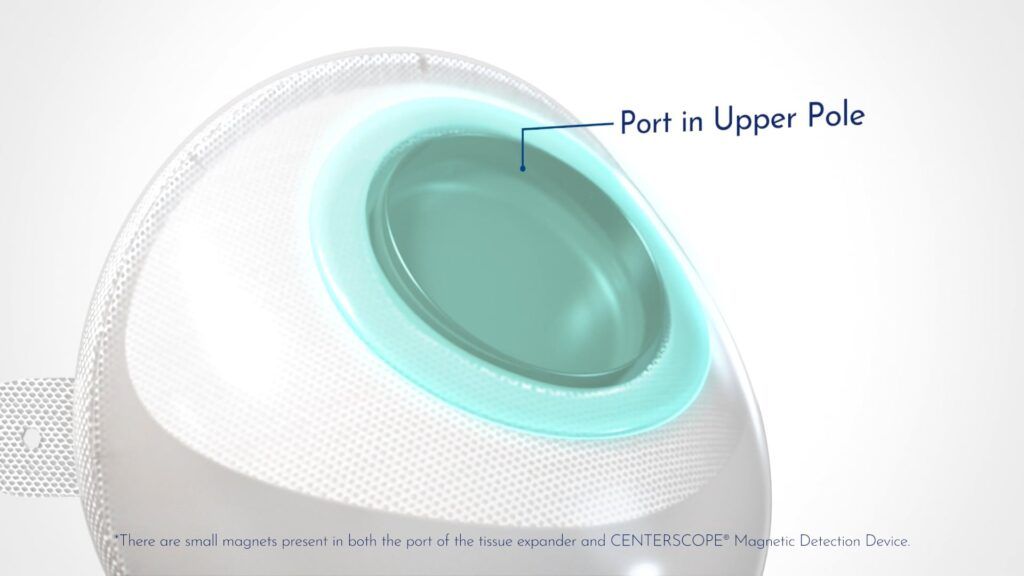 Mentor's Artoura Tissue Expander - Used to expand tissue after a mastectomy before breast reconstruction can occur.