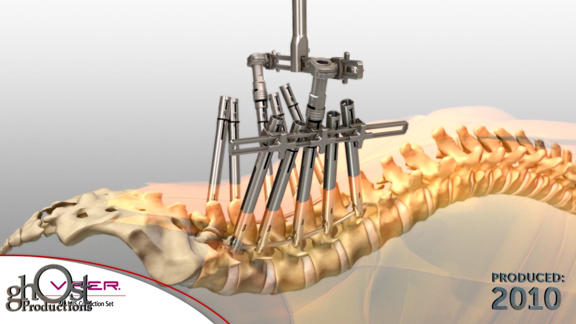 Depuy Viper 3D device, minimally invasive tool, thoracolumbar spine, Ghost Productions, animation, L1-L5 vertebrae, correction instruments, spinal medicine, medically accurate depiction, search engines, potential clients.