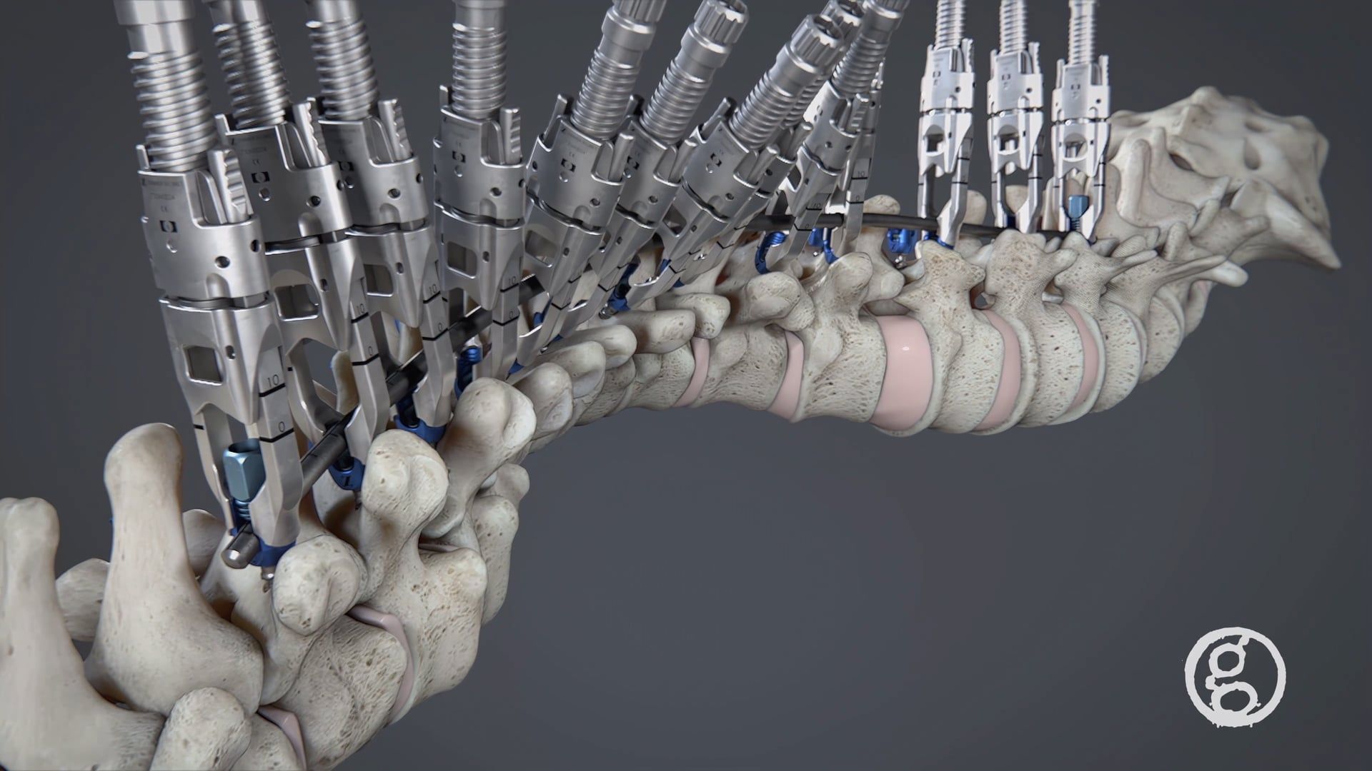 Ghost Medical - Zimmer Biomet - Polaris Deformity Animation