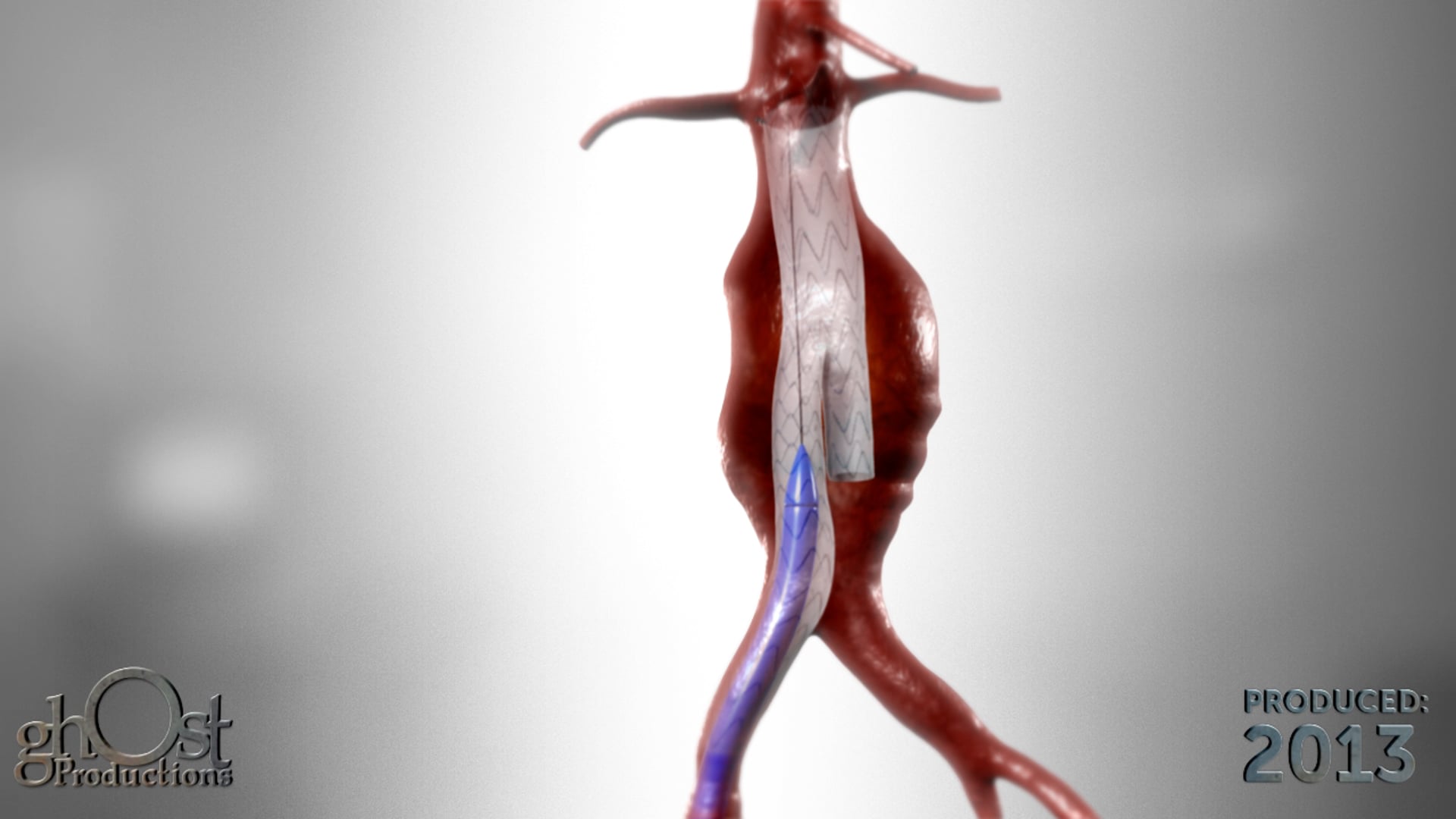 Magnetech, medical device company, Ghost Productions, informative animation, endovascular aneurysm repair, EVAR, abdominal aortic aneurysms, AAA stent main body, contralateral stent graft limb, magnetic coupling catheters, vascular surgery, patient outcomes, groundbreaking EVAR procedure.