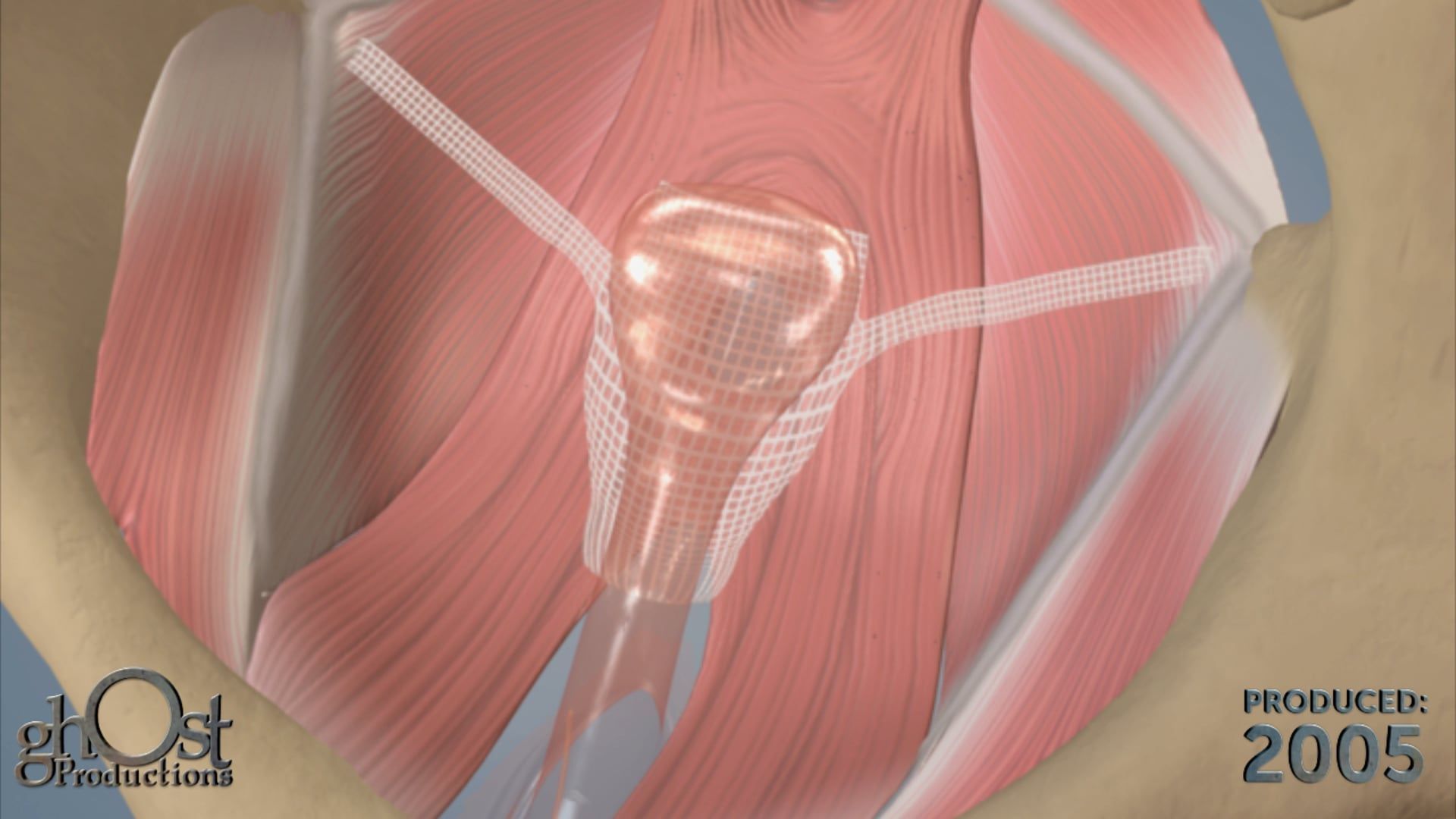 Ghost Productions offers a comprehensive animation of the Apogee vaginal mesh pelvic floor replacement for vaginal prolapse and reconstruction.