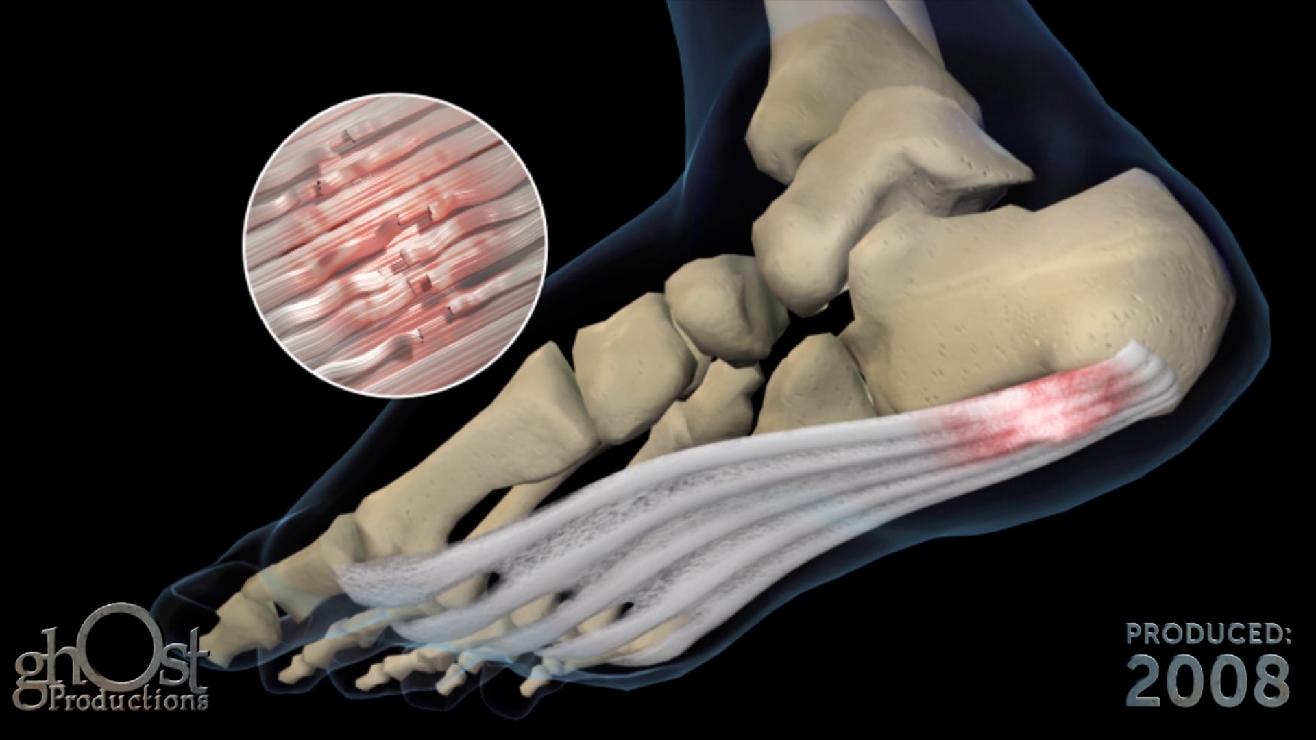 Gramedica, medical device company, Ghost Productions, animation, Plantar Fasciitis, pathology, inflammation, plantar fascia, misalignment, heelbone, HyProCure implant, alleviate symptoms, medically accurate, healthcare professionals, patients, understanding, benefits, orthopedics, foot and ankle surgery.