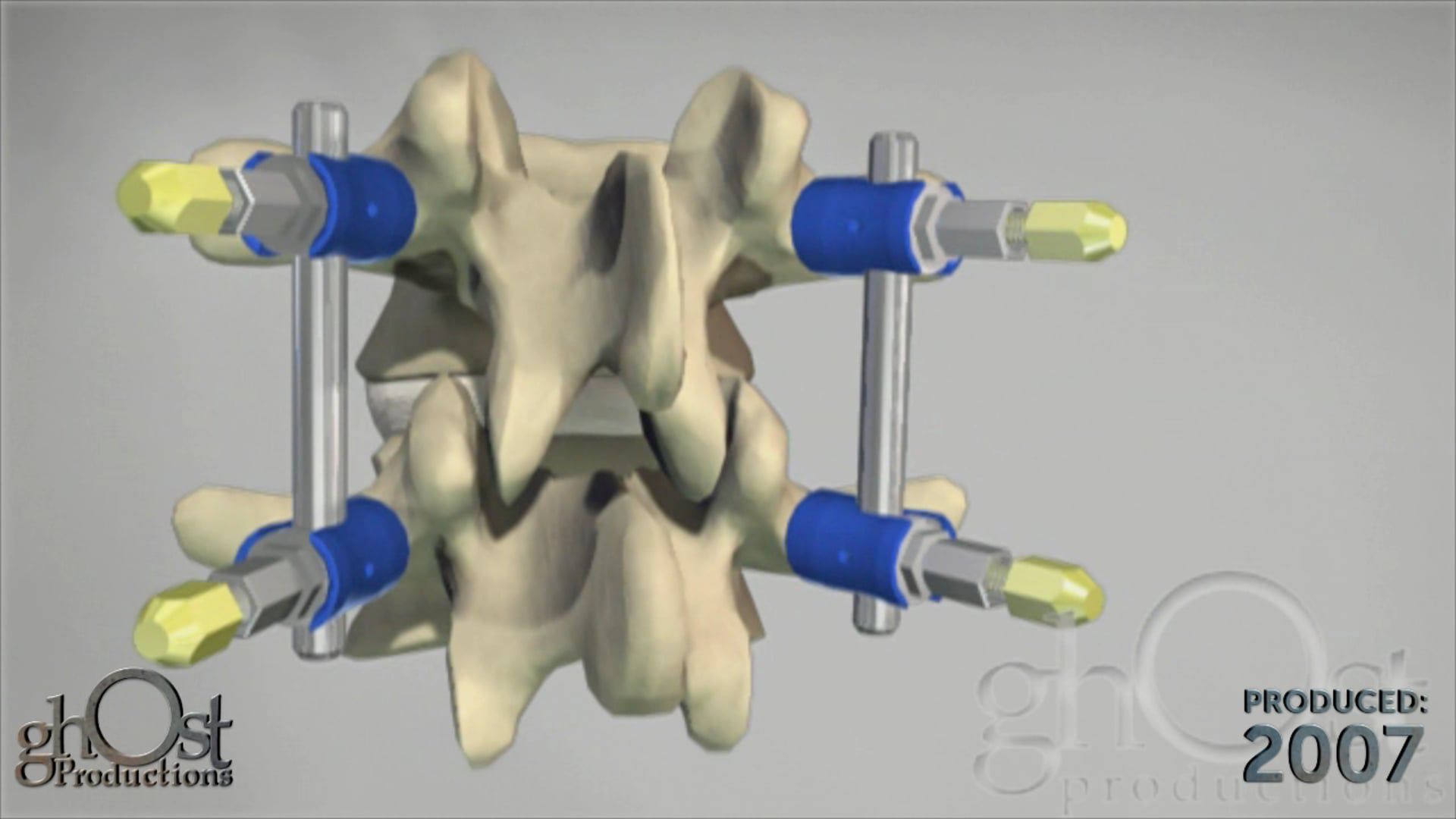 Life Spine, Ghost Productions, Arx pedicle screw system, medical device company, spinal fusion procedures, orthopedic surgery, game-changer, superior stabilization, support, flexibility, precision, cutting-edge technology, surgeons, control, accuracy, complex spinal procedures, benefits, top choice, medical technology.