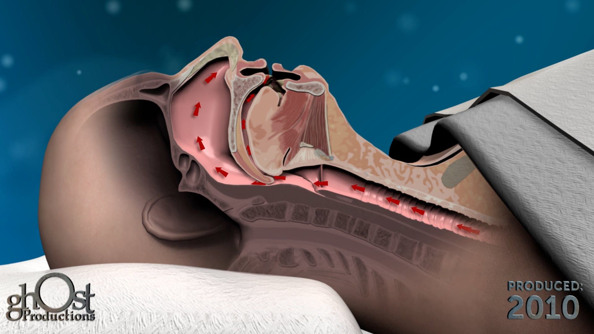 Watch Ghost Productions' animation explaining sleep apnea and the need for Apnex Medical's innovative device to improve sleep quality.