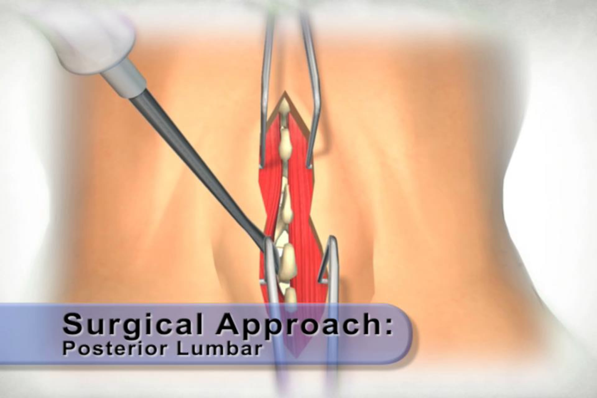 medical animation, posterior lumbar surgical approach, step-by-step guide, skin retraction, muscle retraction, soft tissue retraction, educational resource, medical professionals, .edu websites, .org websites, healthcare industry, Ghost Productions, high-quality animations, medical accuracy.