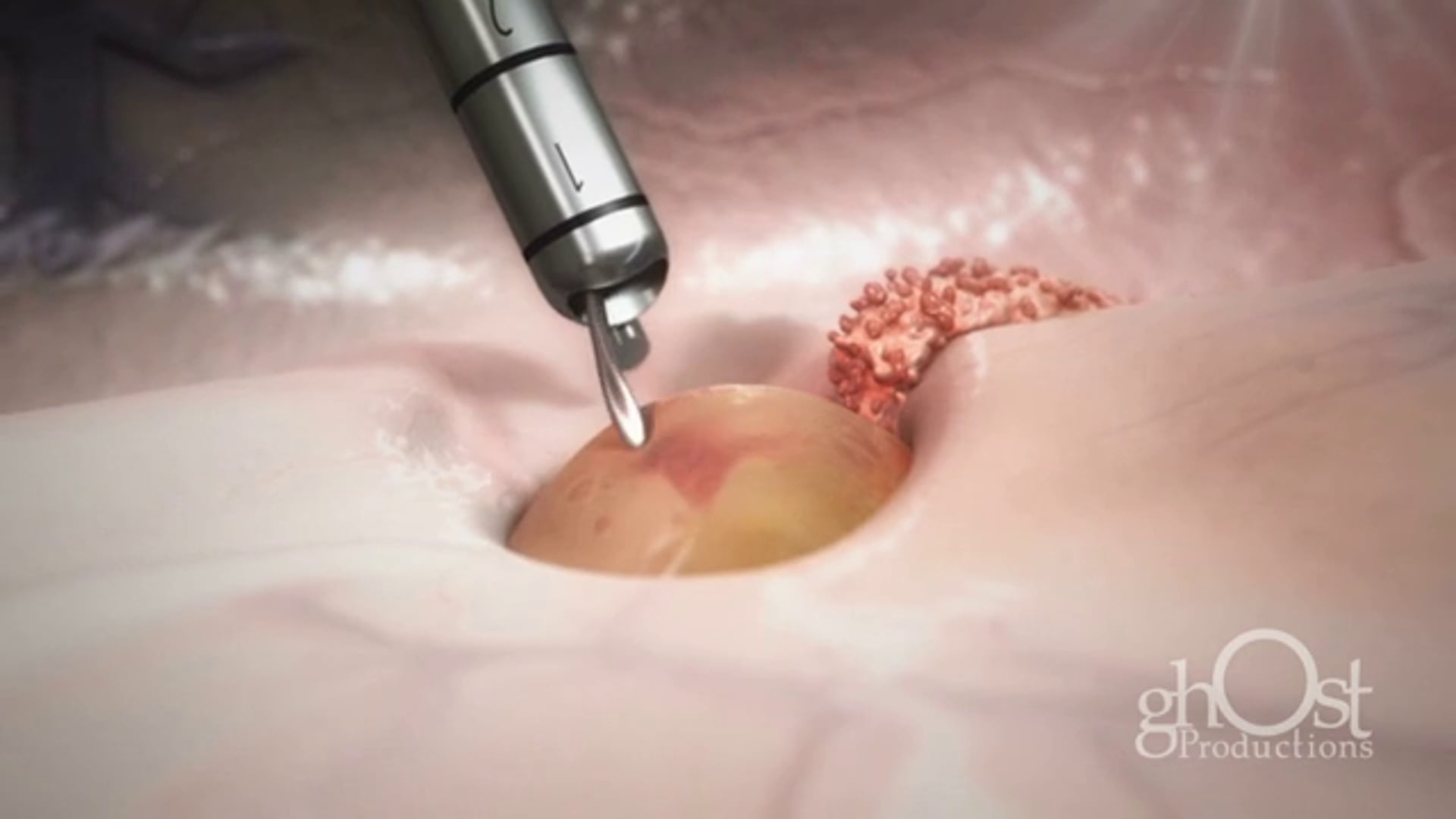 Ghost Medical - Aesculap - MINOP Invent - HD