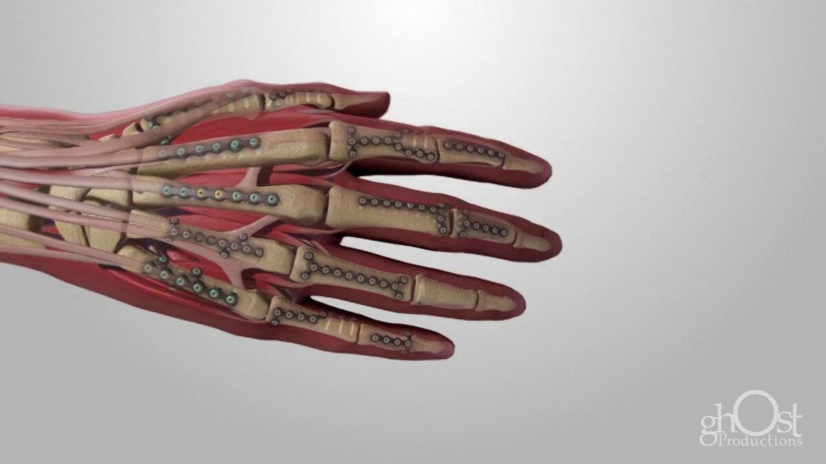 DePuy, orthopedic surgery, plate systems, medical technology, precision, effectiveness, advanced medical technology, patient outcomes, medical professionals, innovative products, visually stunning, medically accurate, Ghost Productions.