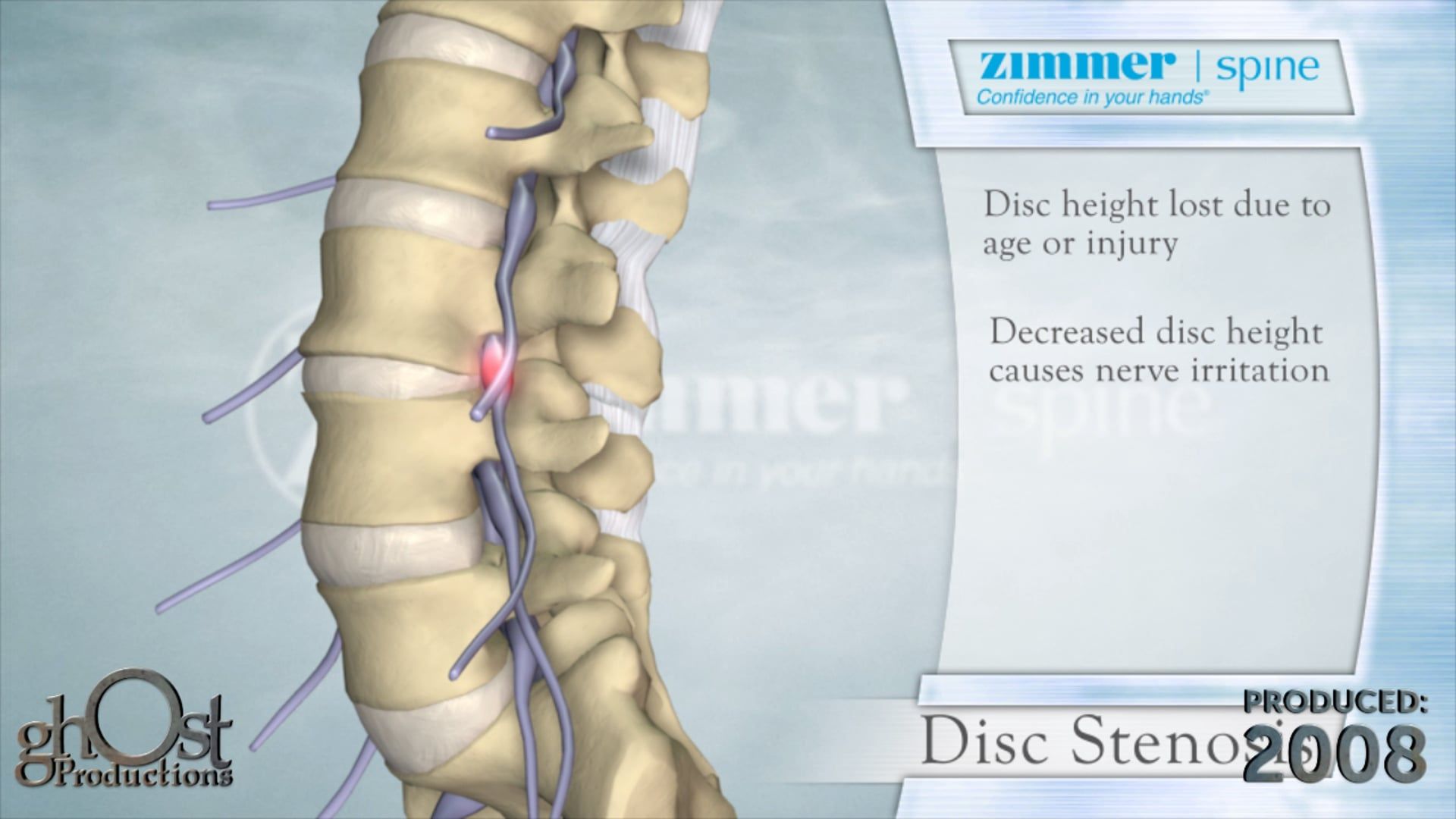 Zimmer Spine, Ghost Productions, Disc Stenosis, spinal discs, spinal canal, nerve compression, back pain, numbness, weakness, innovative products, patient outcomes, spinal medicine, healthcare professionals, patients, medical device company, informative video.