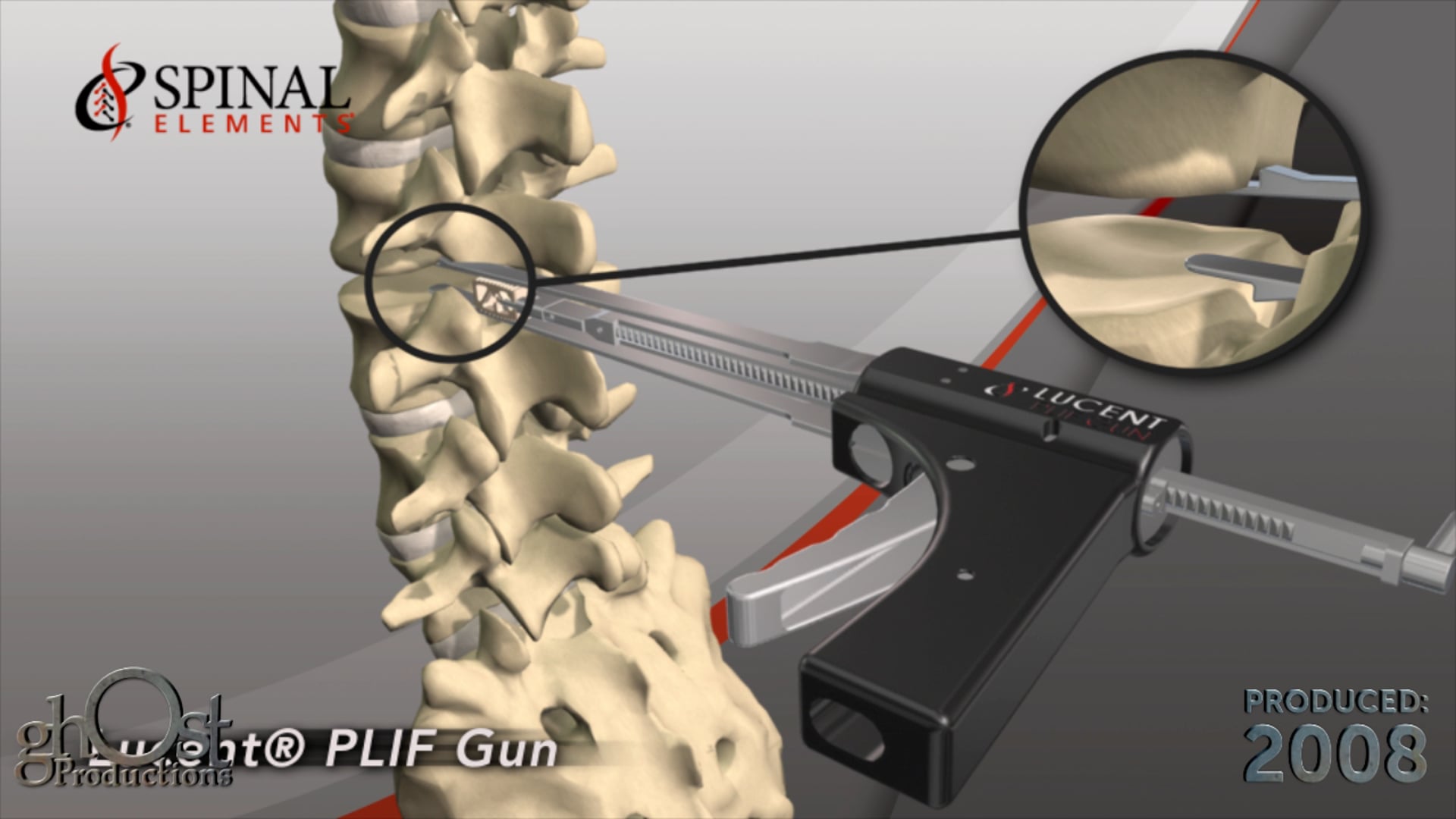 Ghost Medical Presents: Spinal Elements PLIF Animation