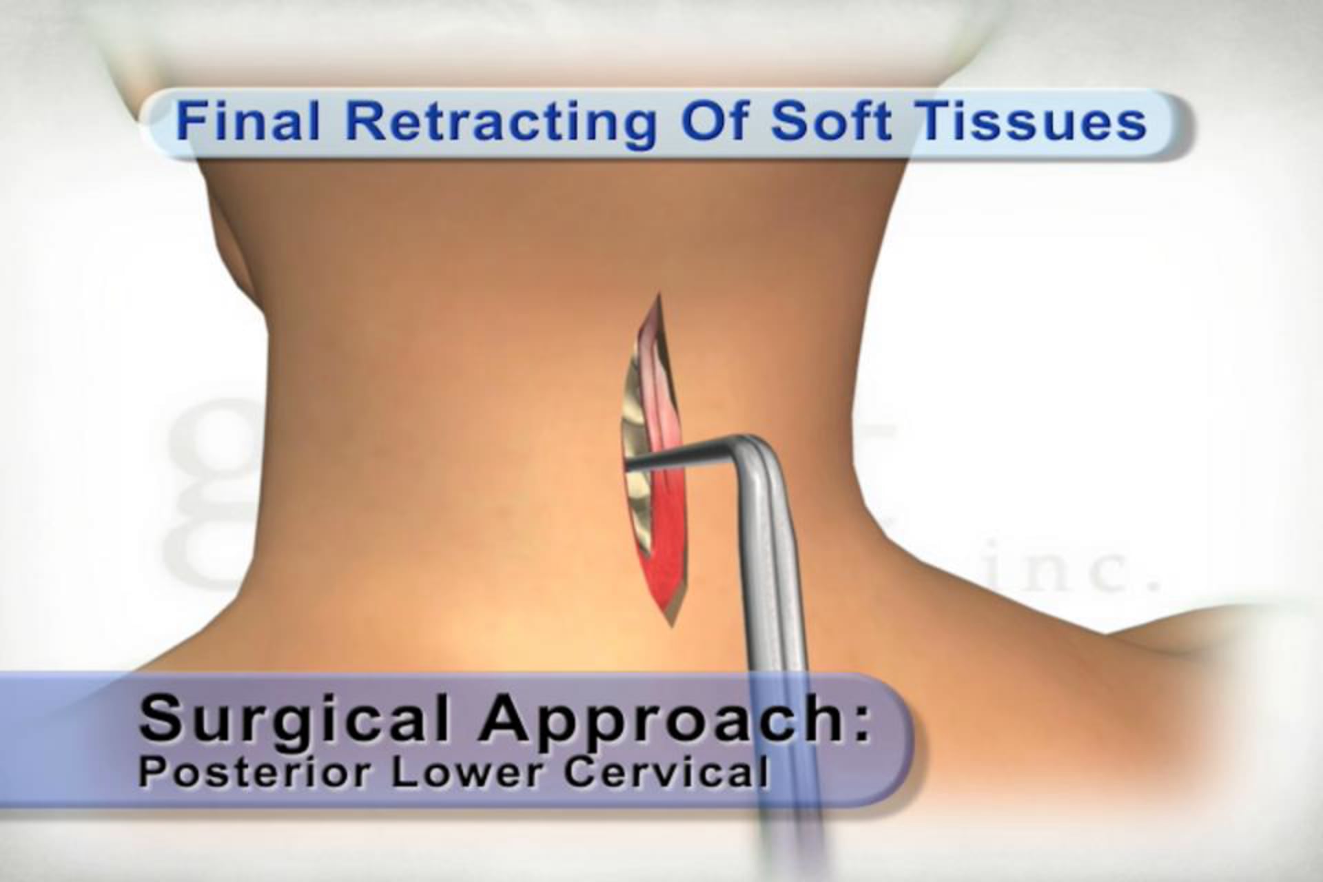 medical animation, posterior lower cervical surgical approach, step-by-step guide, skin retraction, muscle retraction, soft tissue retraction, educational resource, medical professionals, medical students, .edu websites, .org websites, active link, www.ghostproductions.com