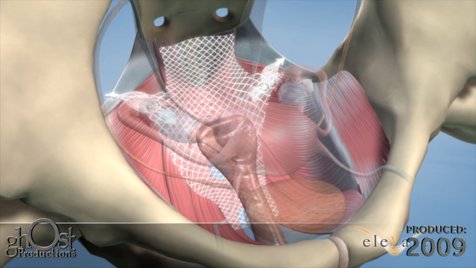 Ghost Medical Presents: American Medical Systems ElevatePosterior