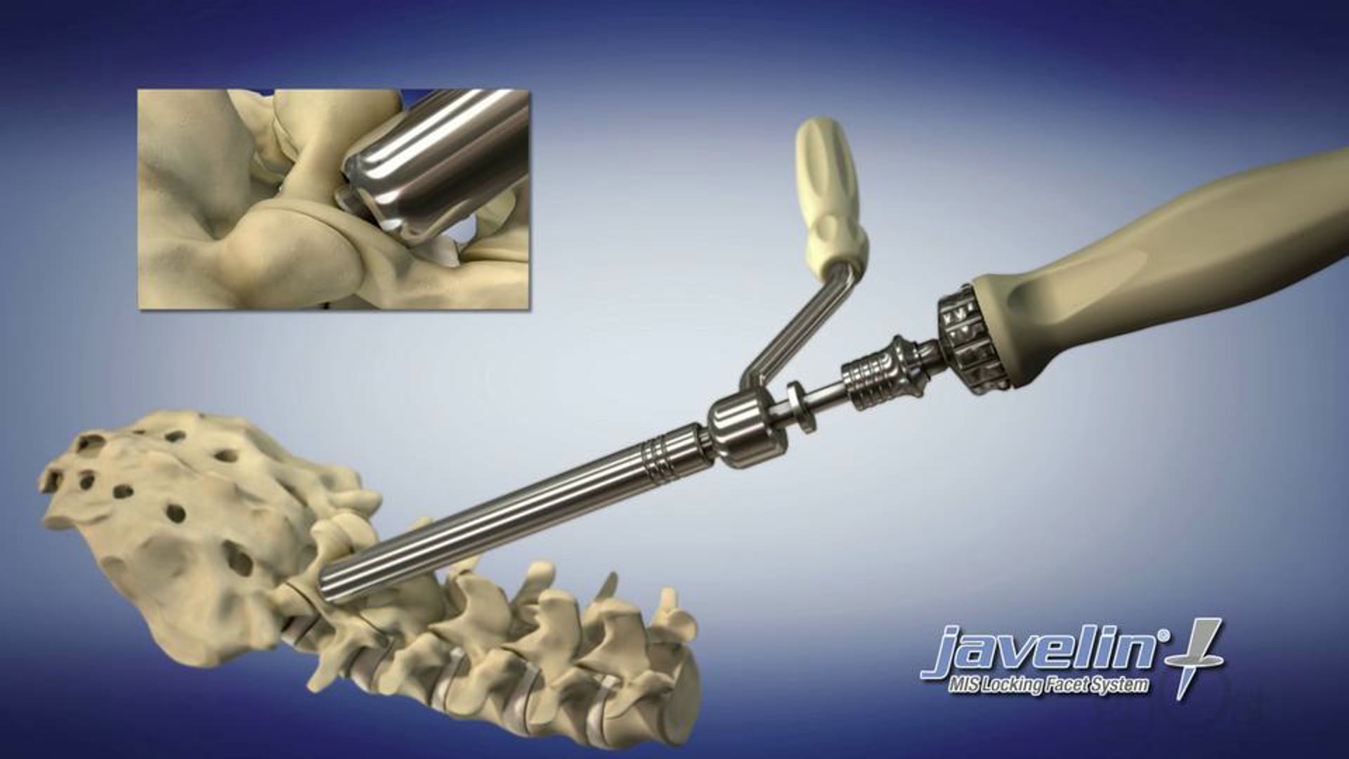 Introducing the Amedica Javelin: A Revolutionary Medical Device by Ghost Medical