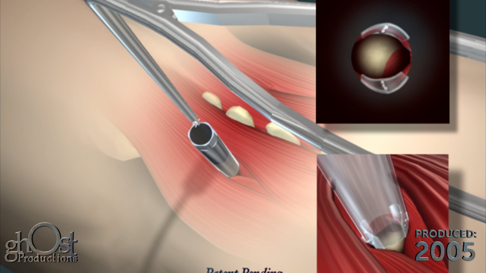 Mitrex device animation, endoscopic surgery aid, surgical visualization, medical animation, endo access port, soft tissue retraction, surgical efficiency, medical device animation, surgical technology, medical education.