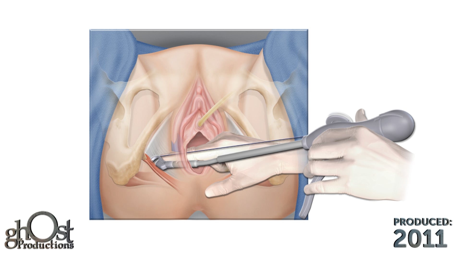 Ghost Medical Presents: Coloplast Digitex