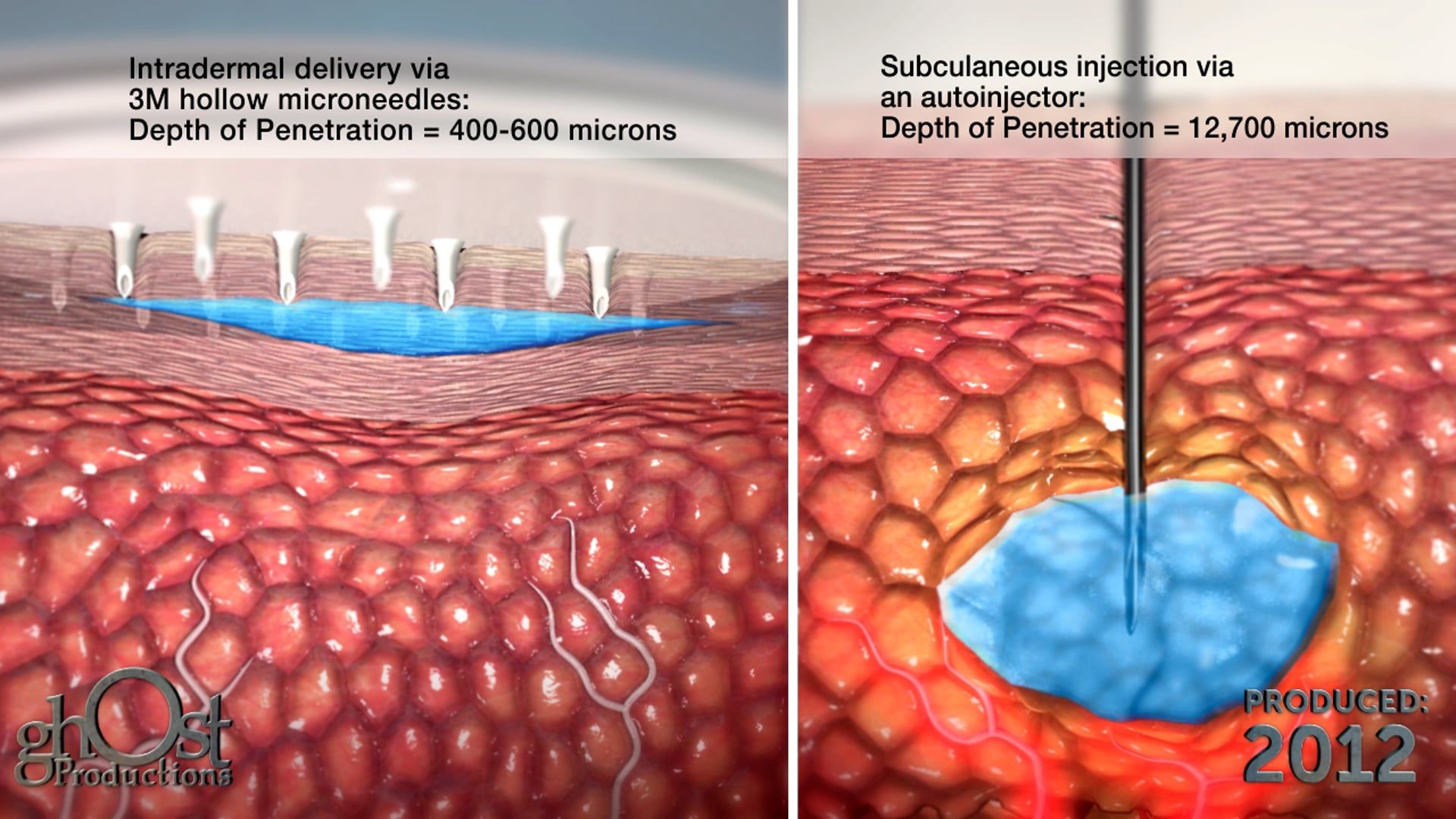 Ghost Medical's 3M Intradermal Delivery System: Revolutionizing Medical Injections