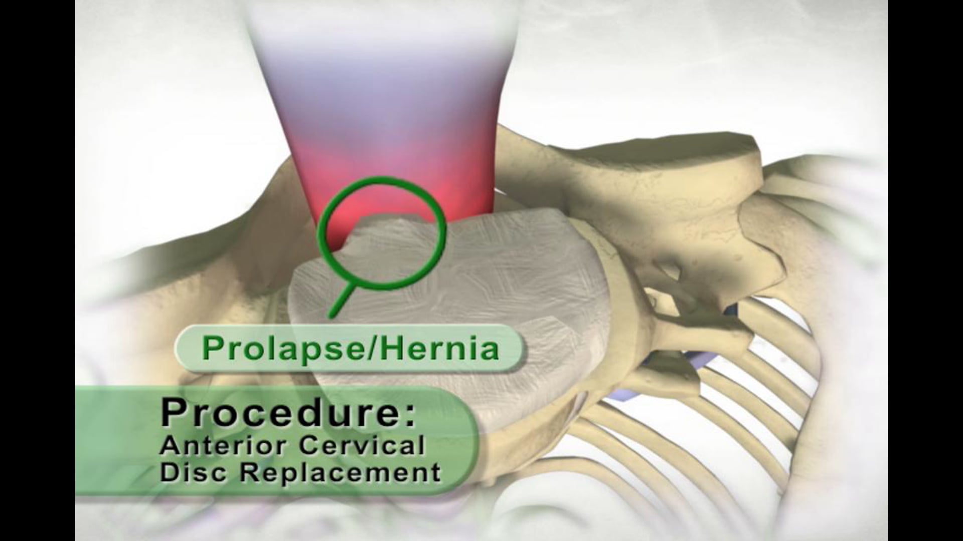 medical animation, Ghost Productions, 2006, prolapsed cervical disc, nerve irritation, pain, shoulder, arms, removal, affected disc, cuts, adjacent vertebrae, artificial disc construct, implant, disc motion, educational resource, medical professionals, freely distributed, .edu, .org, active link, www.ghostproductions.com.