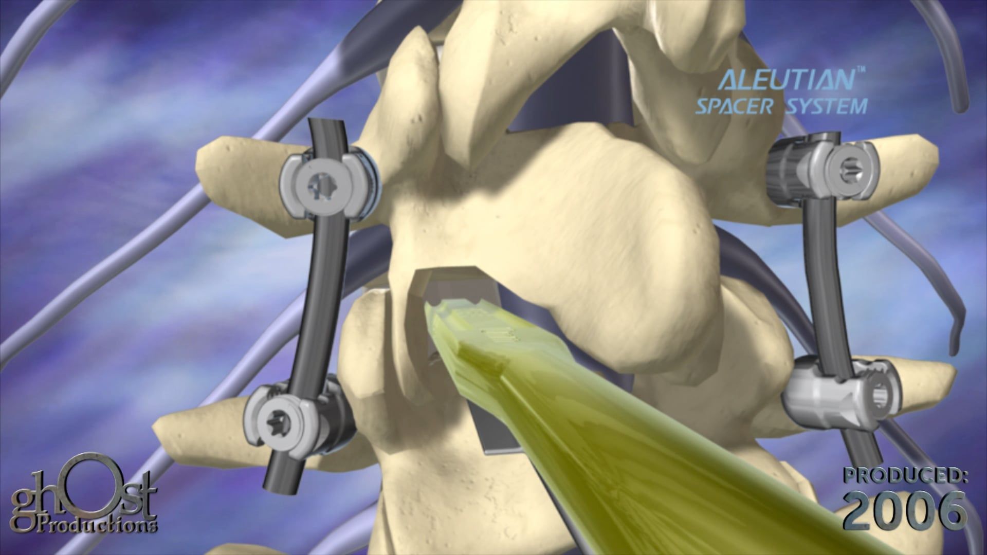 Ghost Productions, K2M, Aleutian device, animation, spacer system, posterior approach, pedicle screw fixation system, stability, support, spine, orthopedic surgery, medical professionals, understanding, benefits, informed decisions, patient care.