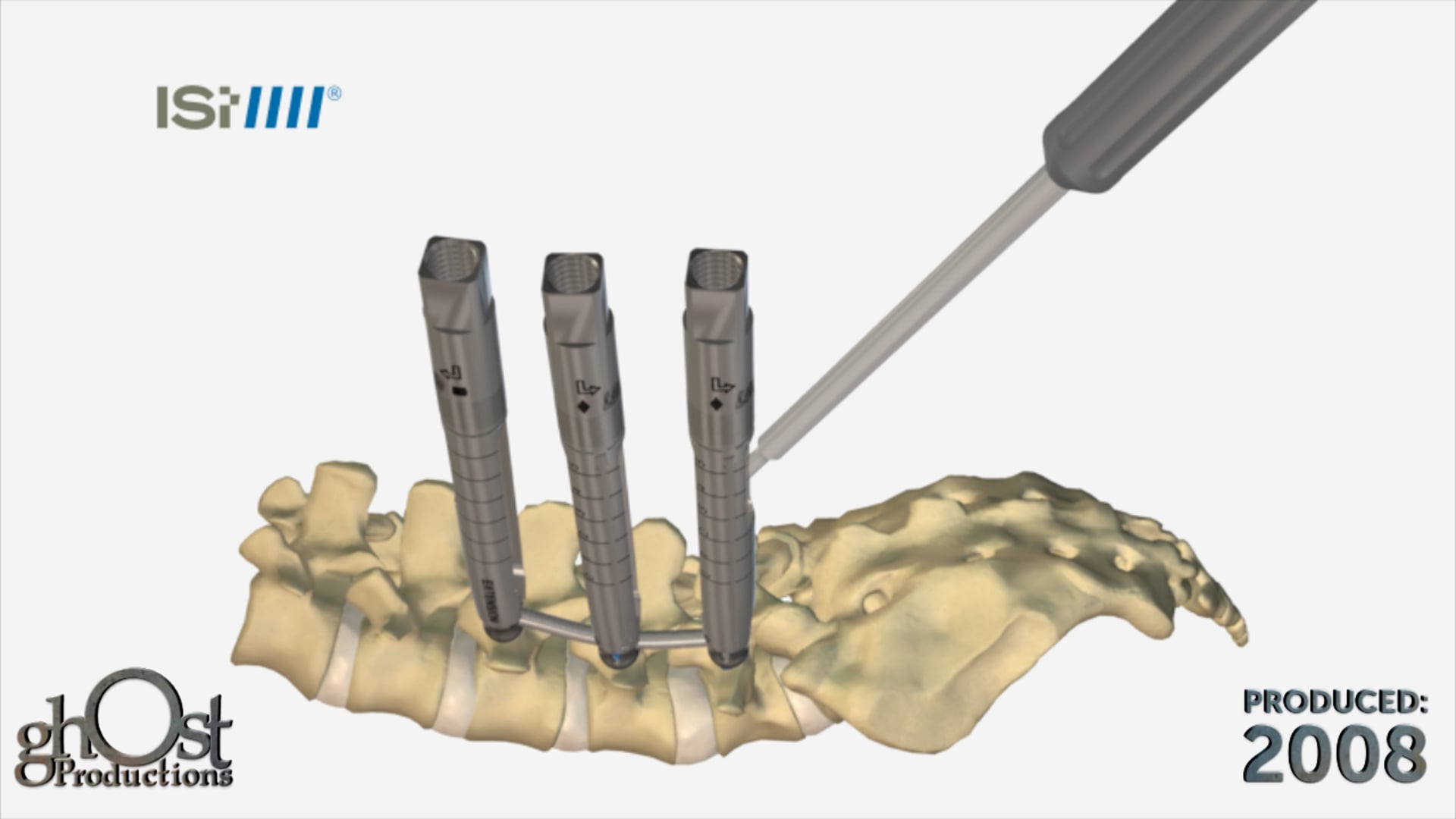 Innovative Spinal Technology Showcase by Ghost Medical