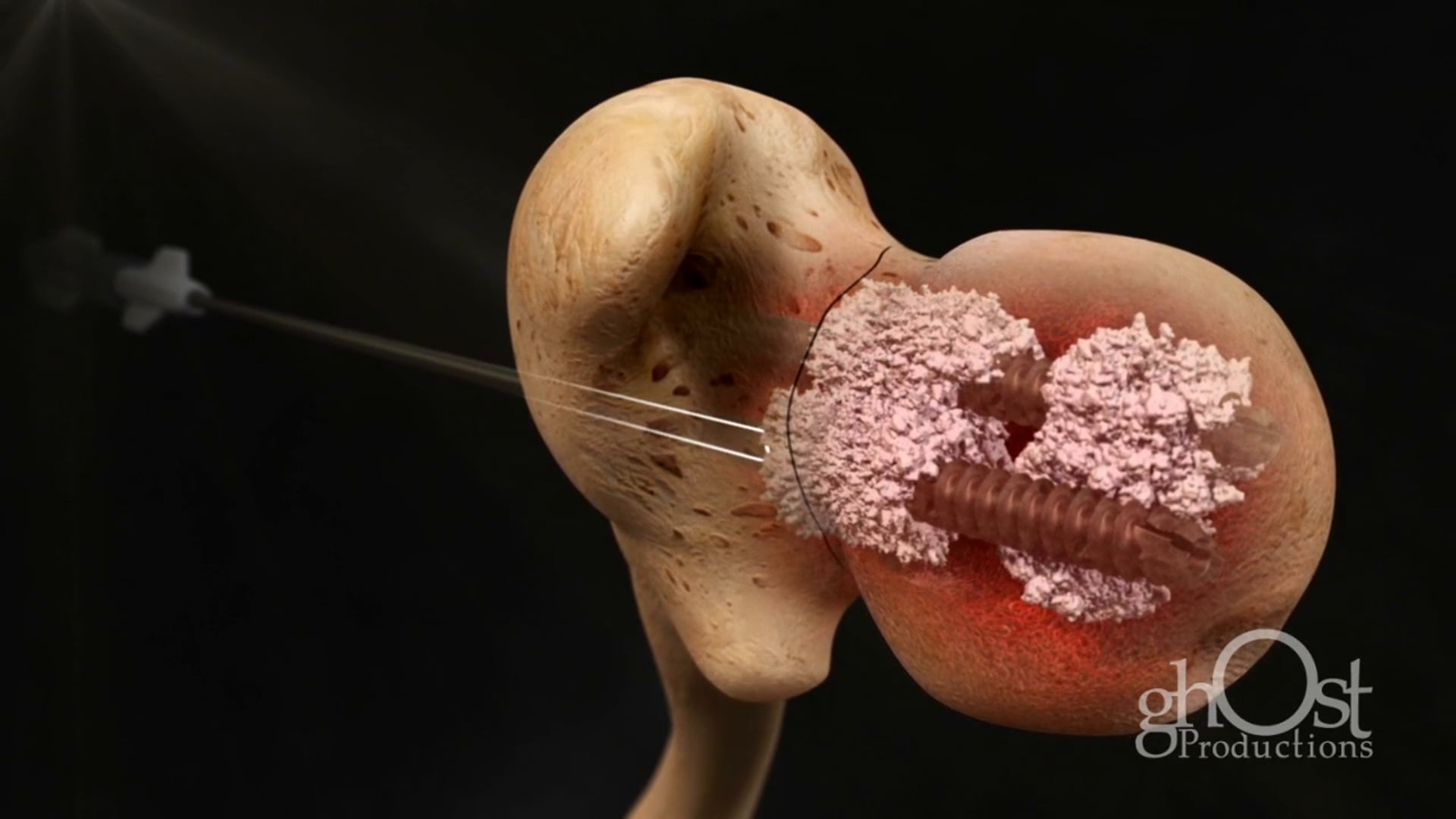 Ghost Medical - Orthogen - FlowFX - HD