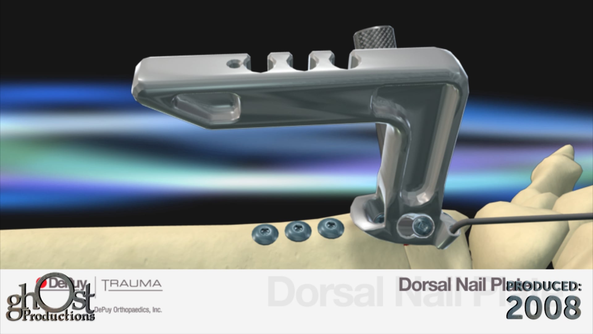 Depuy Trauma, Ghost Productions, surgical technique animation, Dorsal Nail Plate device, minimally invasive treatment, extra-articular distal radius fractures, innovative device, unique features, benefits, patients, surgeons, medical professionals, orthopedic medicine, visually stunning, medically accurate.