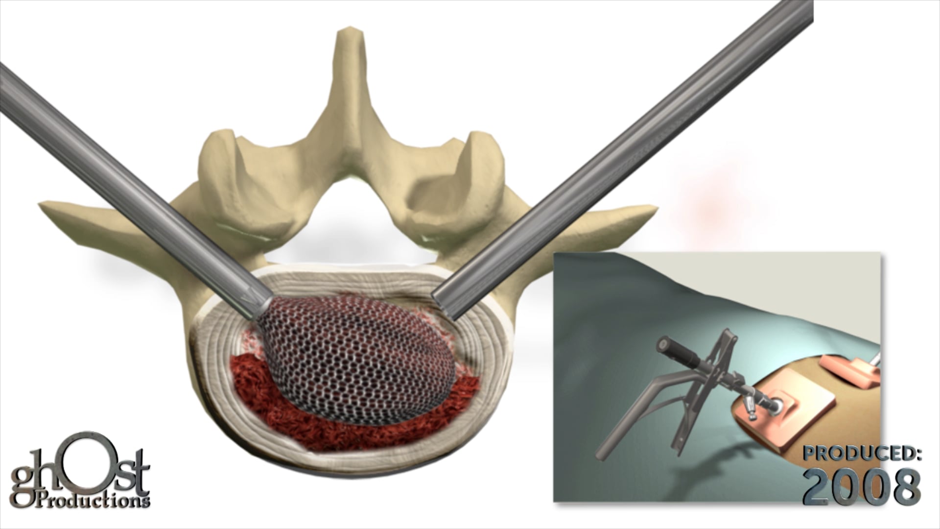 Ghost Productions provided Spineology with an updated technique animation of its Spineology OptiMesh system. The Optimesh is an interbody system that features a mesh implant with expanding instrumentation. The system is filled in situ with granular bone graft.