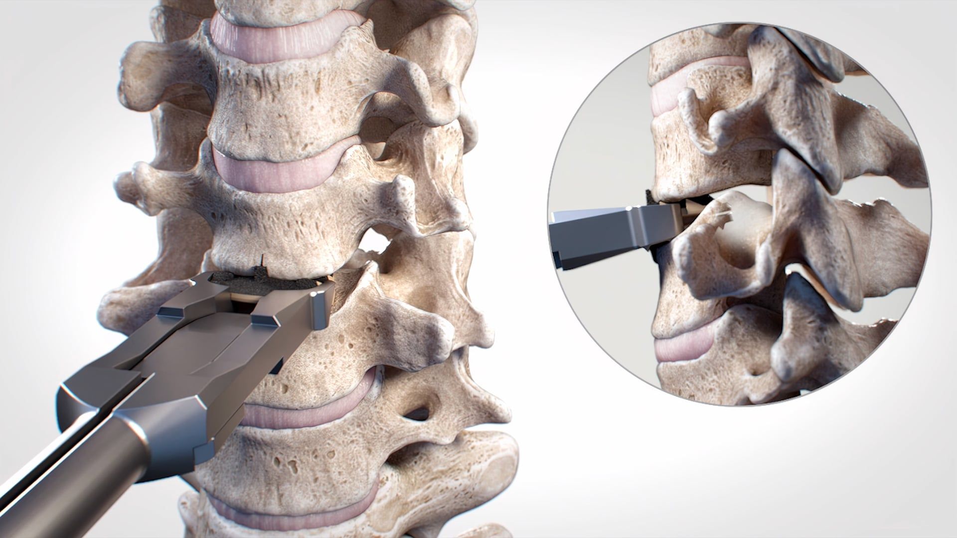Ghost Medical - NuVasive - Streamlining Disc - ADR Surgical Method
