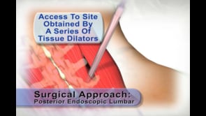 medical animation, posterior endoscopic lumbar surgical procedure, minimal incision site, tissue dilators, surgical site, portal cannula, educational resource, medical professionals, .edu websites, .org websites, Ghost Productions, 2006