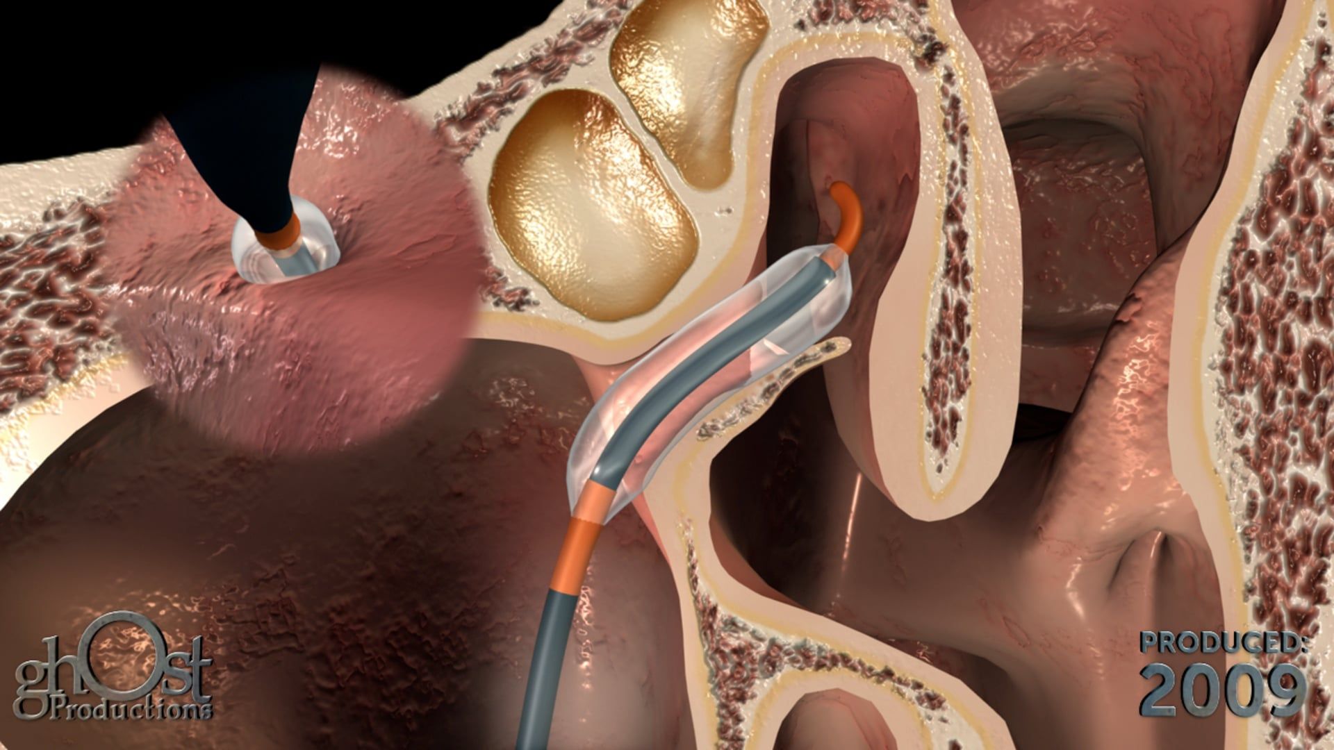 Ghost Medical Presents: The Entellus FinESS Procedure