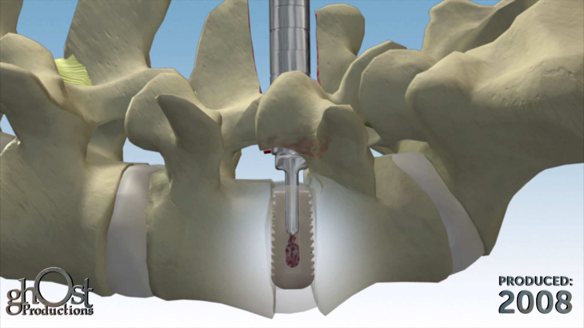 Revolutionizing Medical Education with Ghost Medical's Abbott Cadence