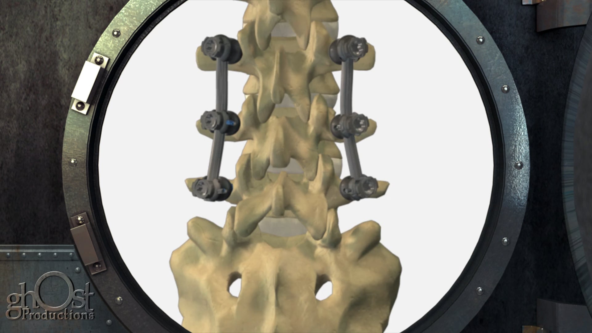 Innovative Spinal Technologies' Paramount Pedicle Screw System by Ghost Medical
