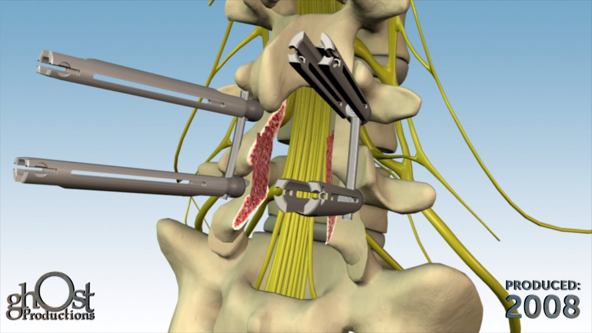 Abbott Pathfinder Patient Education by Ghost Medical