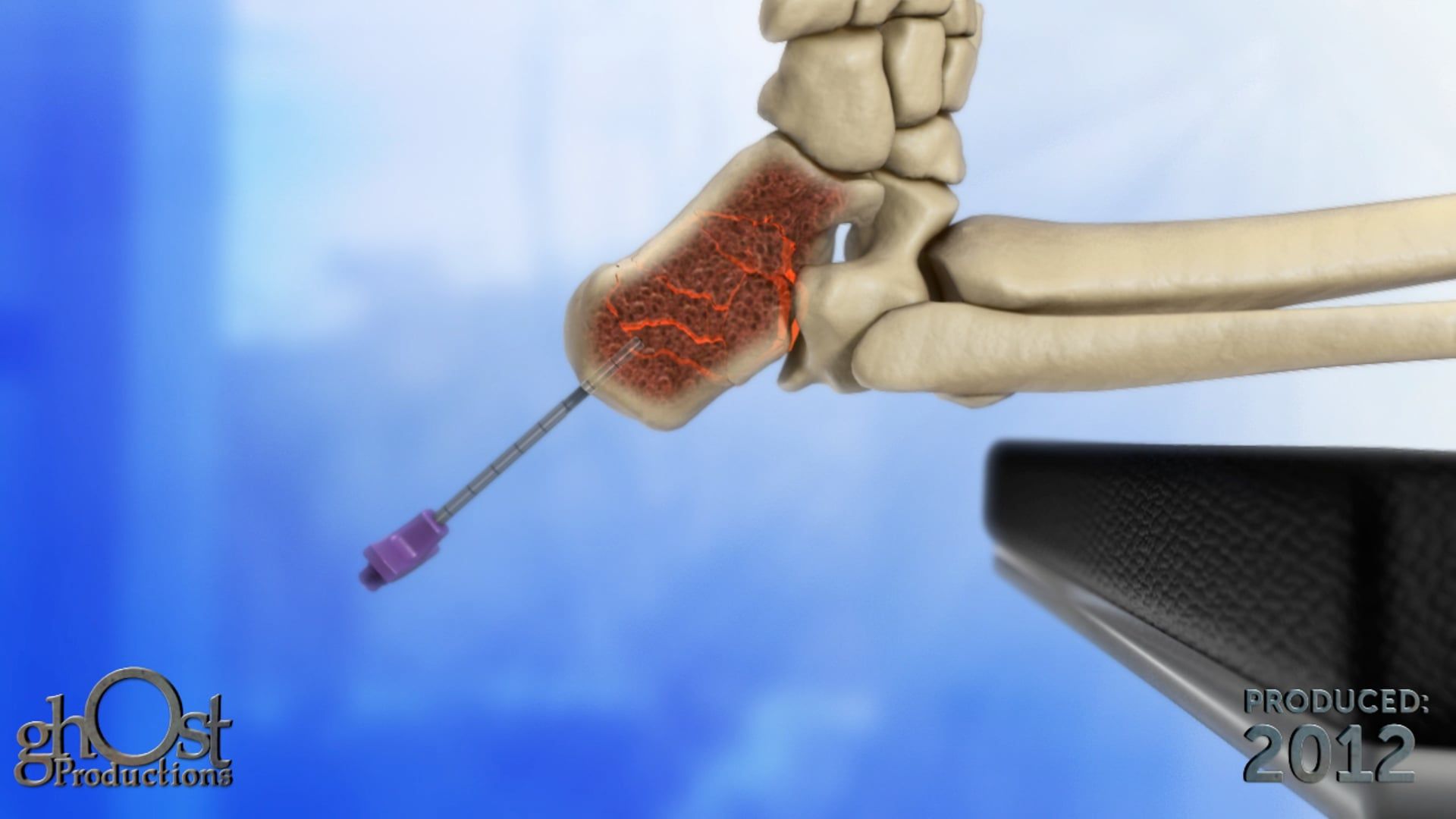 Medtronic, Ghost Productions, Kyphon Balloon Kyphoplasty, vertebral compression fractures, fractured heel bone, calcaneus, balloon inflation, special cement injection, fracture stabilization, medical animation, healthcare professionals, patient education, mobility restoration, medical technology, informative video, medical device, procedure benefits.