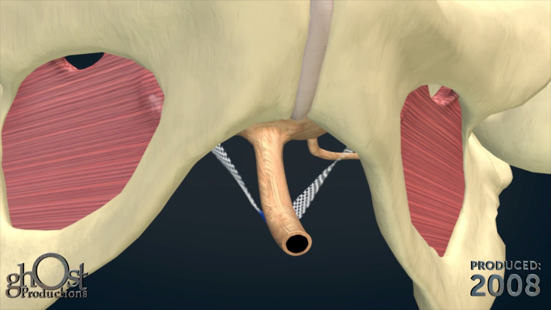 Ghost Productions' animation showcases the MiniArc vaginal mesh, designed to treat bladder and vaginal prolapse without biologic mesh. Gain a better understanding of this innovative device with our expertly crafted animation.