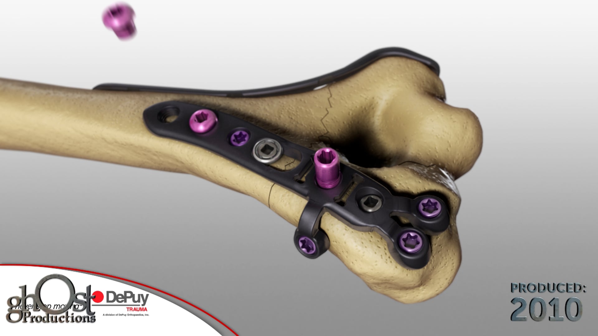 Depuy's Elbow System, medical animation, elbow fractures, orthopedic medicine, medical device, Elbow Plating System, fixed angle locking screws, low-profile metaphyseal screws, accurate treatment, medical accuracy, best possible care, medical professionals.