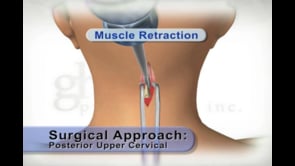 medical animation, posterior upper cervical surgical approach, step-by-step guide, skin retraction, muscle retraction, soft tissue retraction, educational resource, medical professionals, medical students, .edu websites, .org websites, active link, Ghost Productions, 2006.